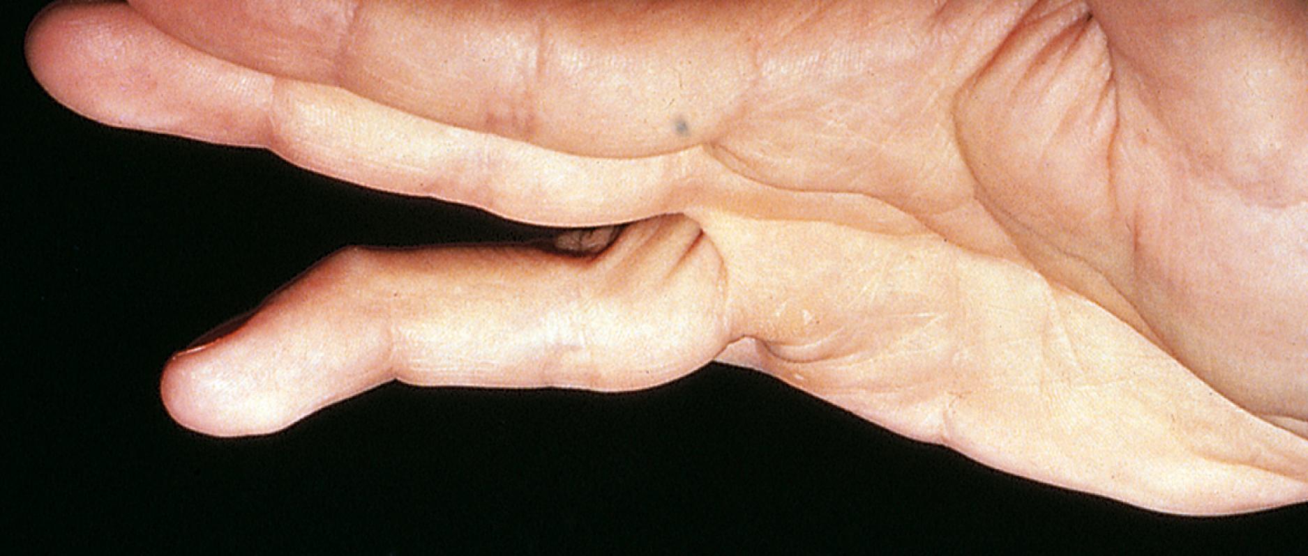 Fig. 22.88, Mallet finger with secondary swan-neck deformity. This is the result of avulsion of the extensor tendon from its insertion at the base of the distal phalanx, which was not recognized at the time of injury. The patient shows a flexion deformity of the distal interphalangeal joint and secondary hyperextension of the proximal interphalangeal joint.