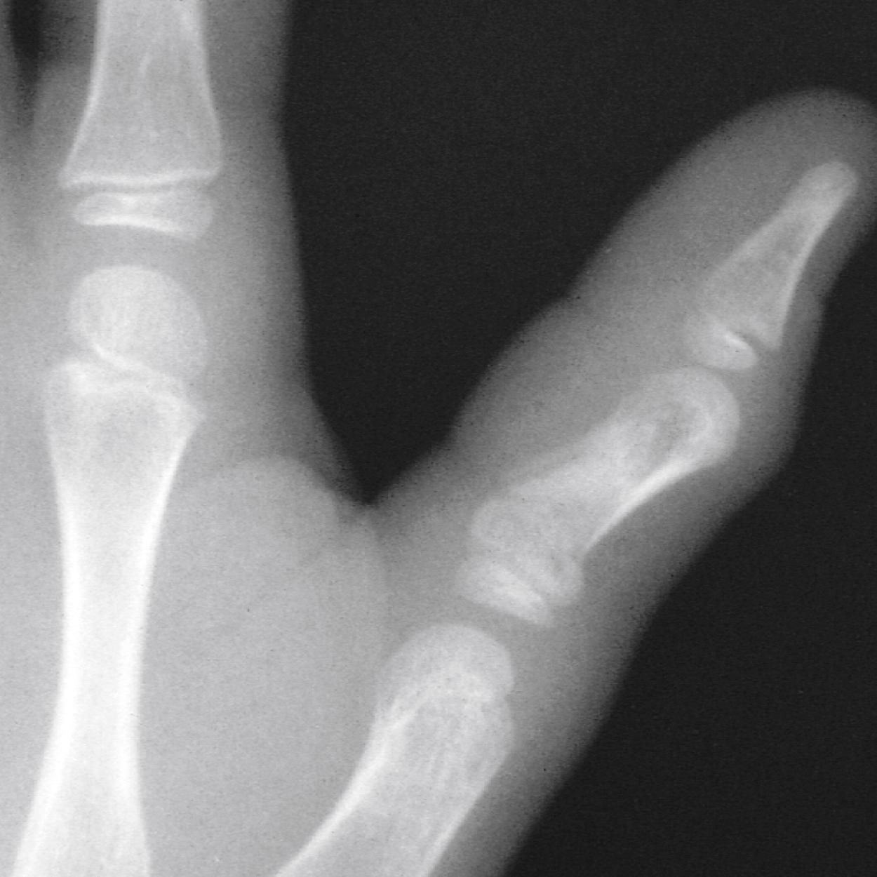 Fig. 22.47, Angulated phalanx fracture. Significant angular deformity is seen in this impaction fracture of the proximal phalanx of the thumb. Such fractures require careful reduction to prevent permanent disability.