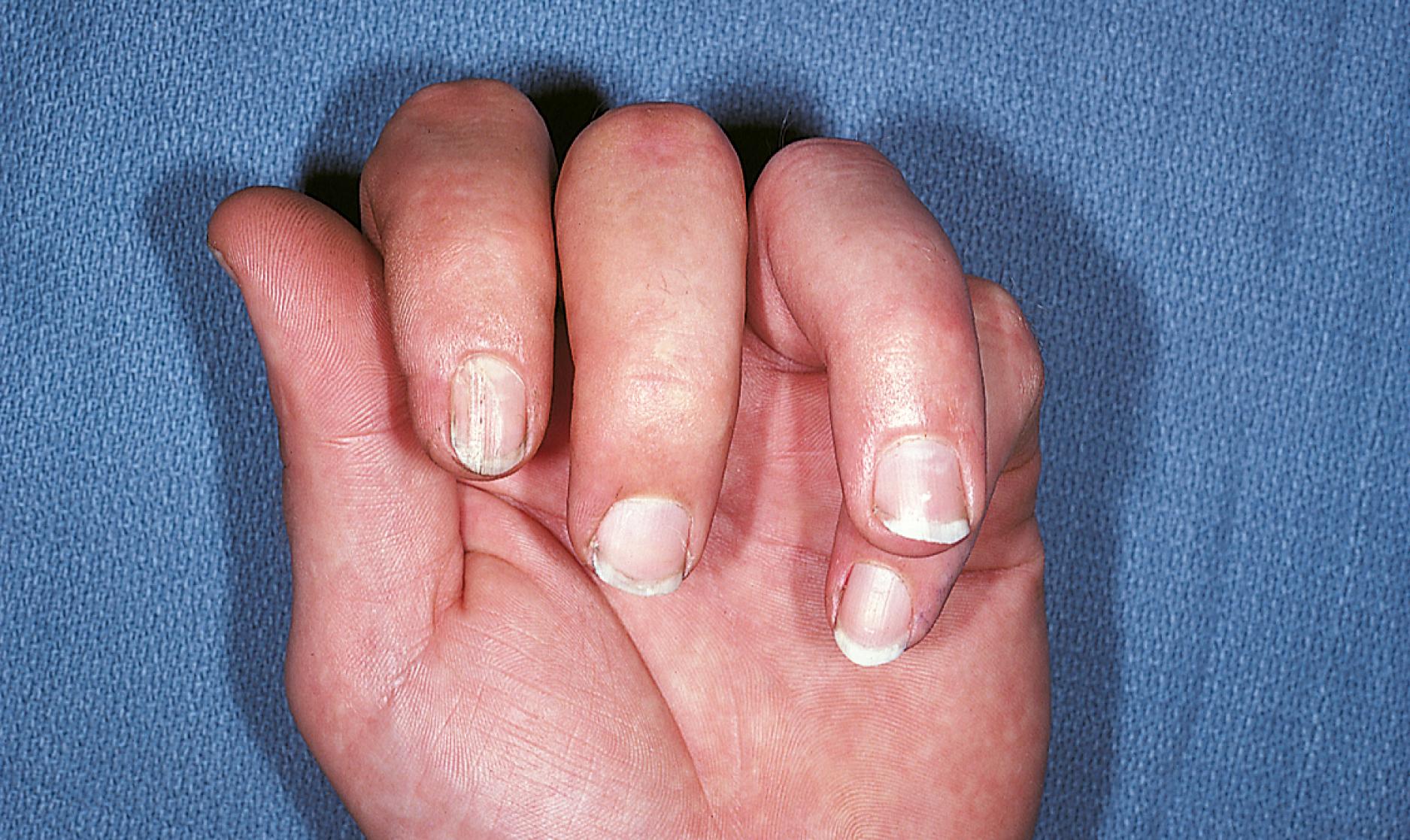 Fig. 22.48, Rotational deformity resulting from a hand injury. With rotational deformity the plane of the nail of the involved finger is seen to deviate from its normal orientation.