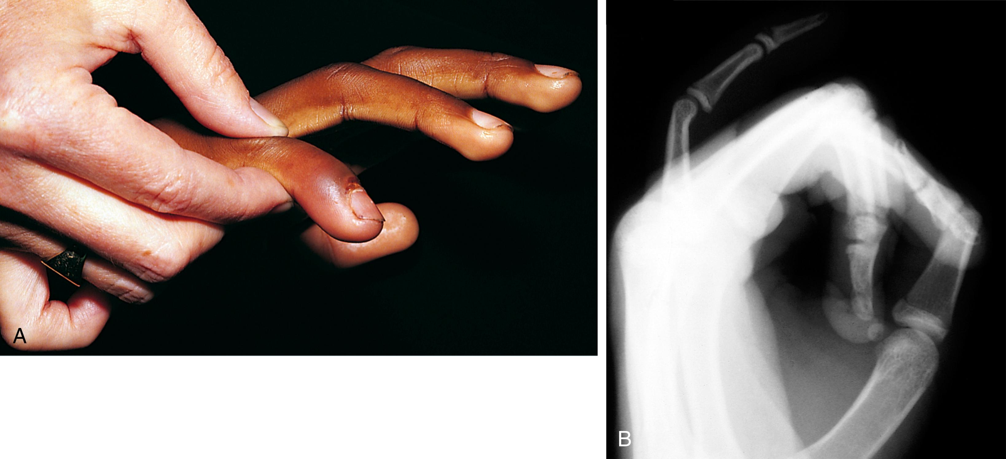 Fig. 22.49, Distal phalanx fracture with extensor tendon injury. (A) Another player’s shoulder landed on this boy’s finger. The finger was swollen and painful and maximally tender at the base of the distal phalanx, and the patient was unable to extend the distal interphalangeal joint. (B) Radiograph revealed separation of the epiphysis at the base of the distal phalanx.