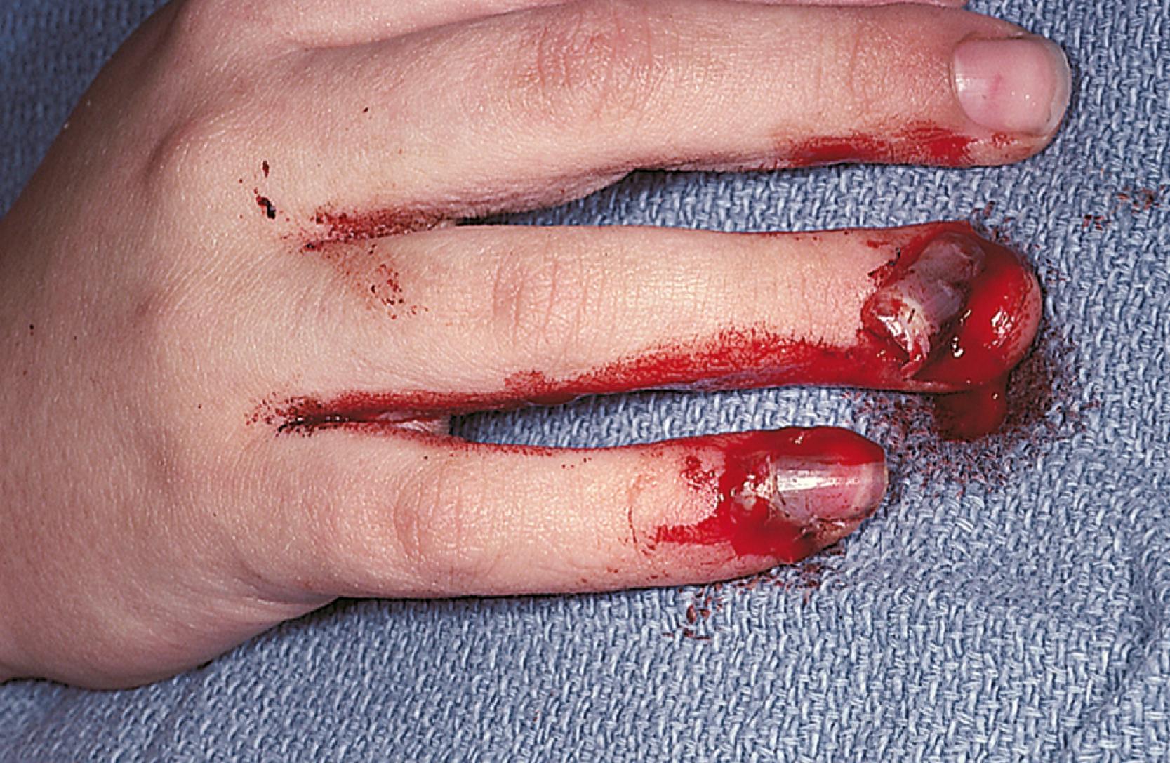 Fig. 22.50, Crush injury of the distal phalanx. This child’s finger was slammed in a car door. He incurred a crush fracture of the distal phalanx, partial avulsion of the nail, and a nail bed laceration. By definition, this is an open fracture.