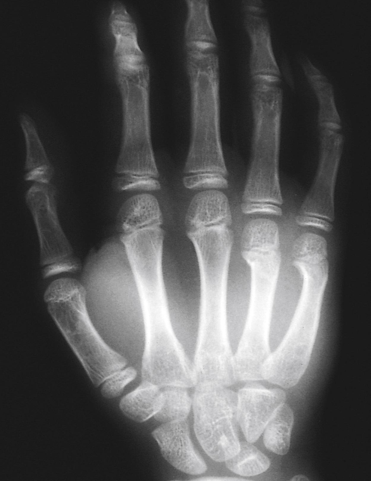 Fig. 22.51, Boxer’s fracture. This adolescent presented with pain and swelling of the lateral aspect of his right hand after punching a wall in a fit of temper. Radiographically he has typical boxer’s fractures of the necks of the fourth and fifth metacarpals with volar displacement of the distal fragments.
