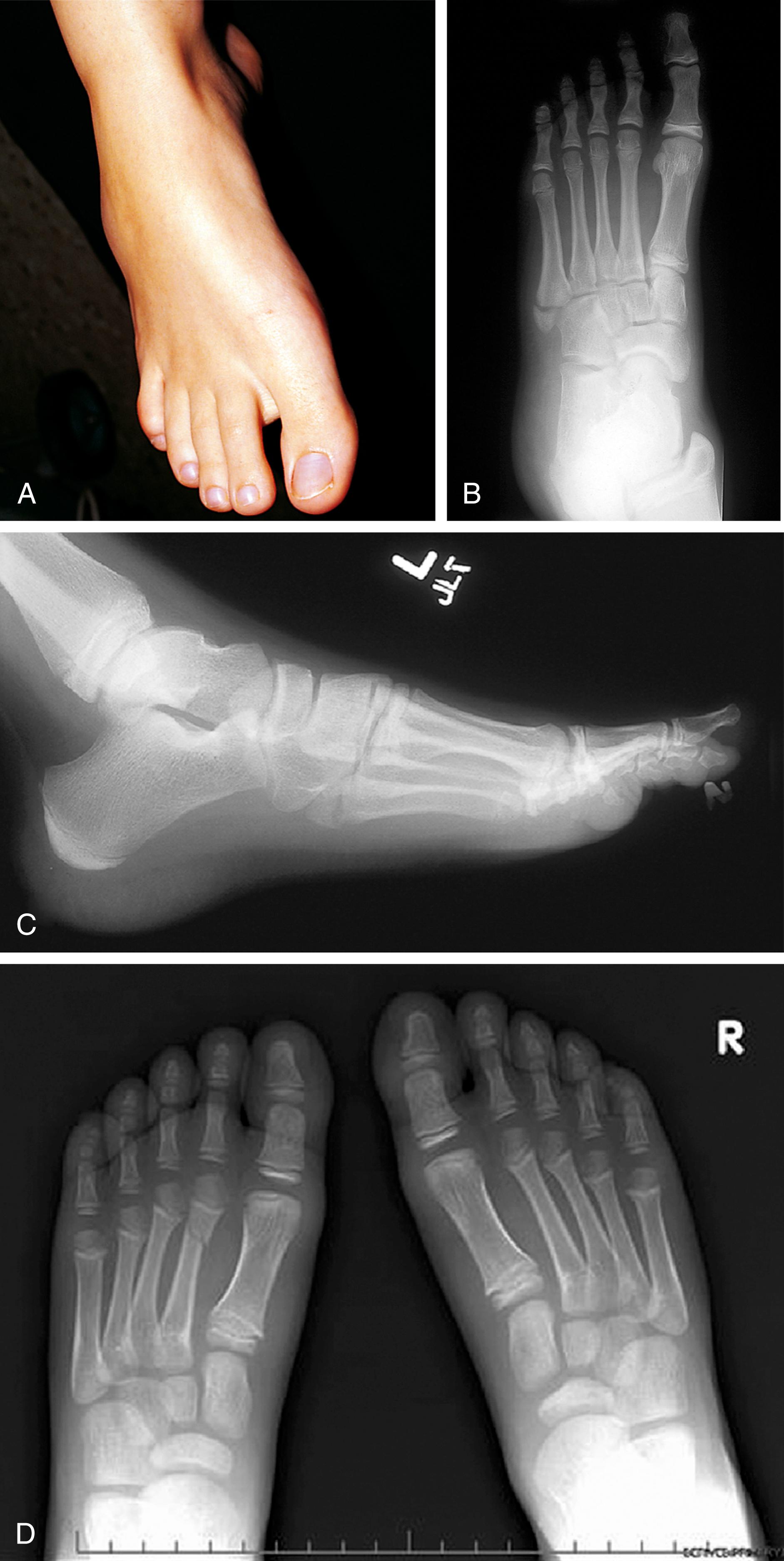 Fig. 22.52, Transverse metatarsal fractures. (A) This adolescent fell forward with her forefoot twisted under her. Swelling over the proximal portion of the fifth metatarsal was prominent. (B and C) Anteroposterior and lateral radiographs show a transverse fracture of the proximal fifth metatarsal. (D) This boy caught his left foot on steps and fell with his forefoot in plantar flexion, thereby incurring a transverse fracture of the distal portion of his second metatarsal.