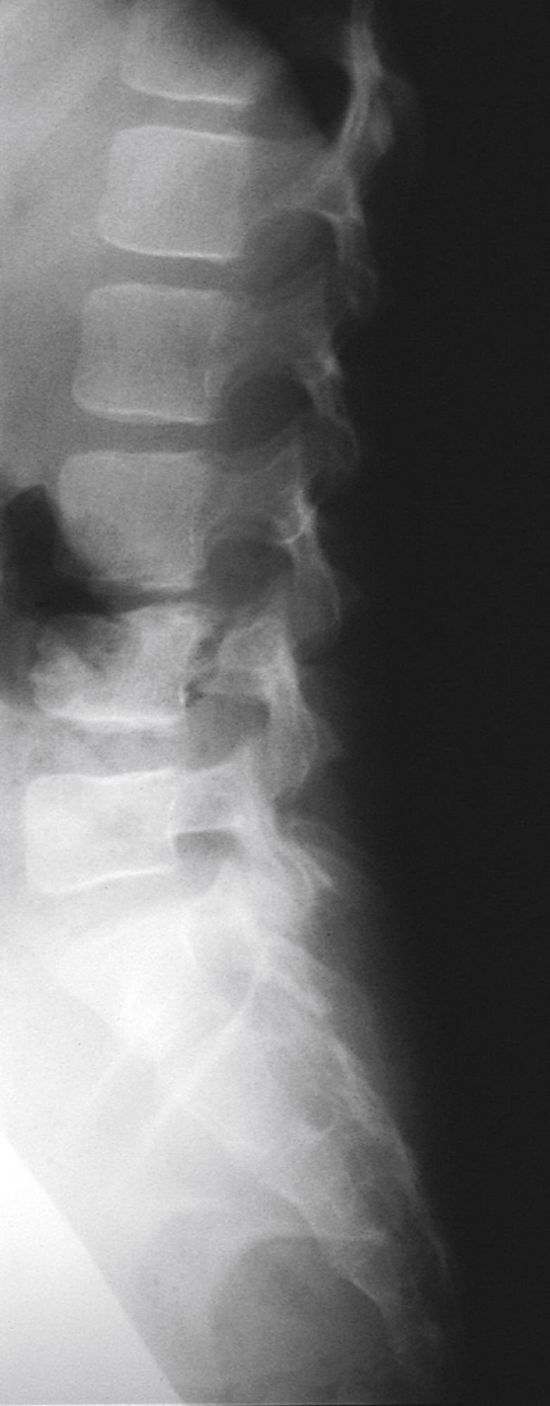 Fig. 22.54, Lap belt fracture. This flexion/distraction injury occurred through the body of the L4 vertebra when the child’s body hyperflexed over a lap belt in a head-on automobile collision.