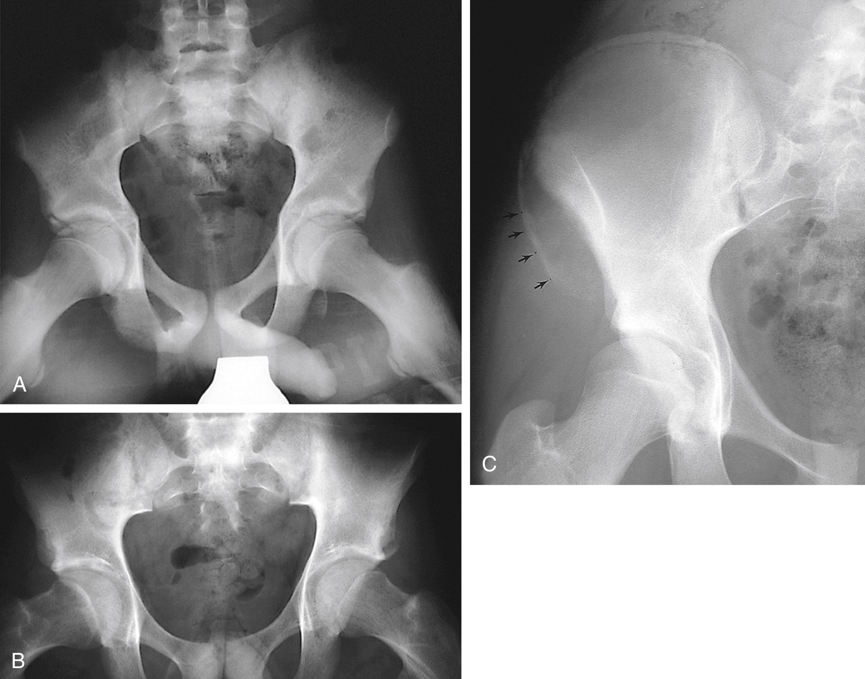 Fig. 22.55, Pelvic avulsion fractures. (A) Ischial tuberosity avulsion fracture. This 14-year-old football player sprinting for a touchdown fell on his stomach and experienced sharp left hip pain. He could not bear weight after the incident and was found to have tenderness over the left buttock and pain with abduction and flexion of the left hip. The avulsed fragment is best seen on this frog-leg view. (B) Anterior inferior iliac spine avulsion fracture. While running in gym class, this 15-year-old boy experienced the sudden onset of left hip pain and difficulty walking. He had point tenderness over the anterior inferior iliac spine and full range of hip motion but experienced pain on flexion and internal rotation. If compared with the right, the avulsed apophysis is evident. (C) Another 15-year-old boy, who developed sudden onset of right hip pain and inability to bear weight while kicking a soccer ball, has a large avulsion fracture of the anterior superior iliac spine (arrows).