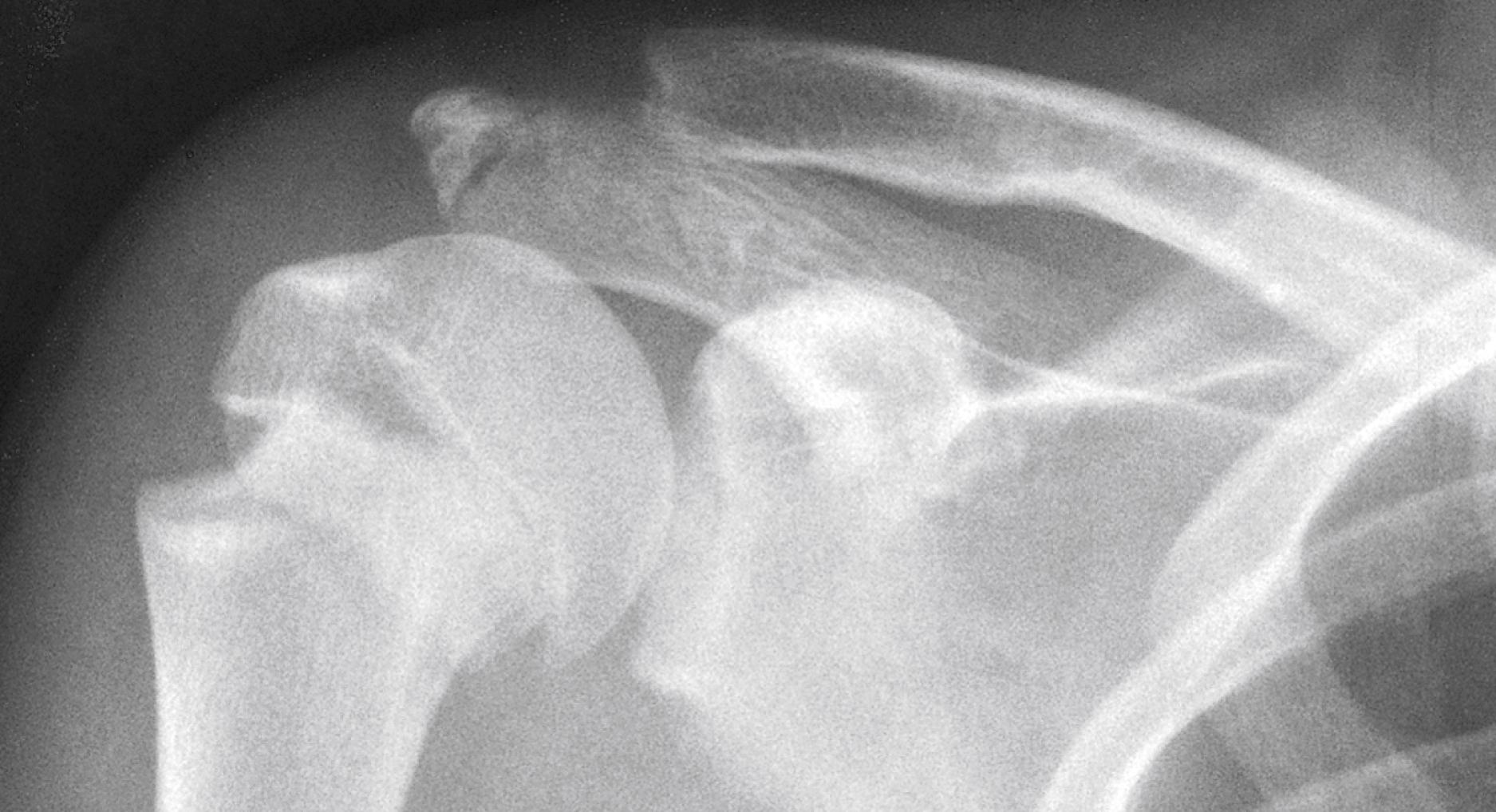 Fig. 22.56, Epiphyseal separation. Because of the elasticity and relatively greater strength of the ligaments, forces that would have resulted in dislocation in an older adolescent have instead caused epiphyseal separation and displacement of the proximal humeral epiphysis in this prepubescent child.