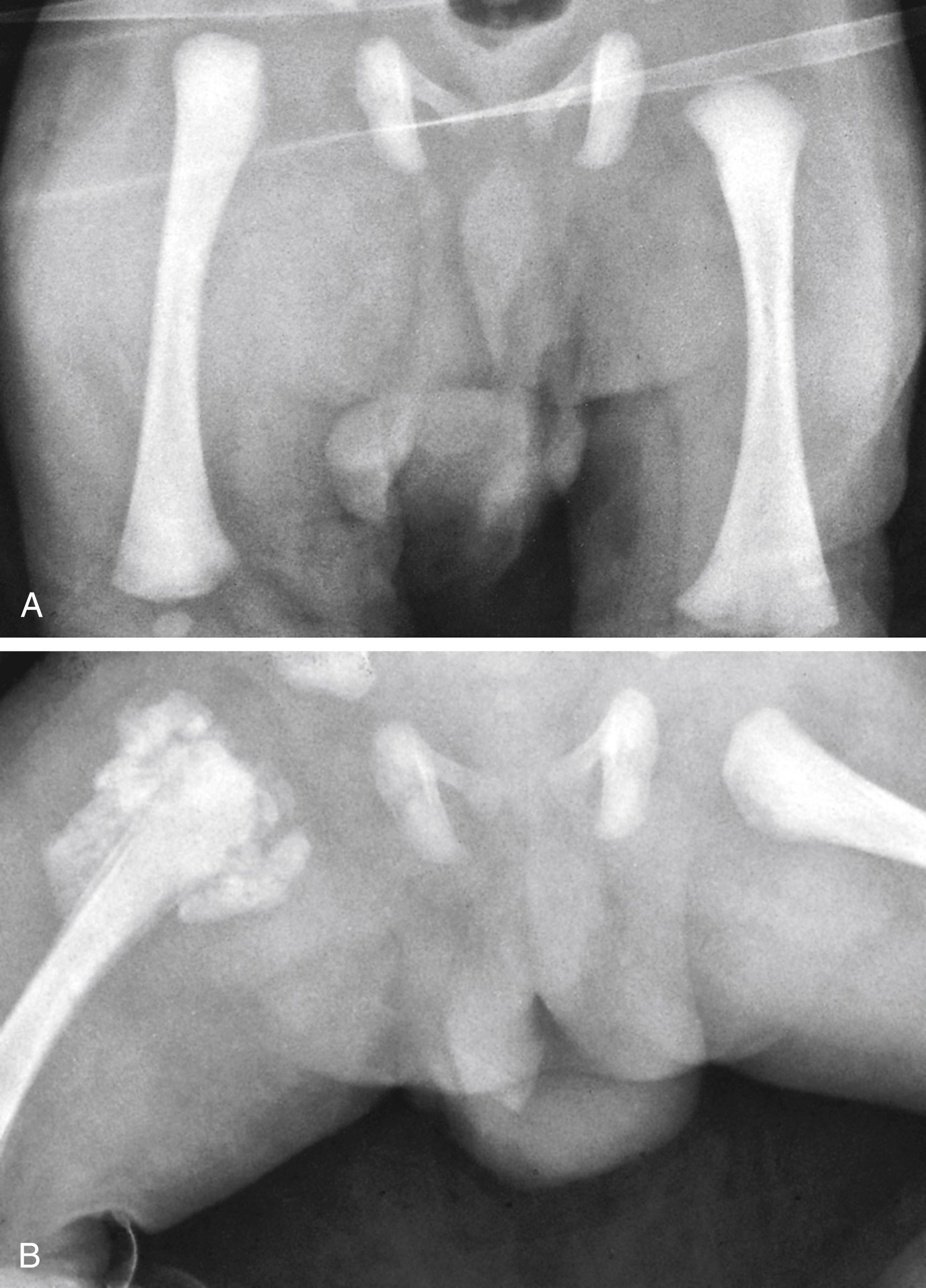 Fig. 22.57, Fracture/dislocation, right hip. This young infant presented after a serious automobile accident with what appeared to be a traumatic hip dislocation without an associated fracture. (A) The right femoral head is displaced laterally and superiorly. (B) The follow-up film taken 2 weeks later reveals vigorous callus formation around the proximal femur and periosteal new bone formation both proximally and distally, thus confirming the existence of associated femoral fractures.