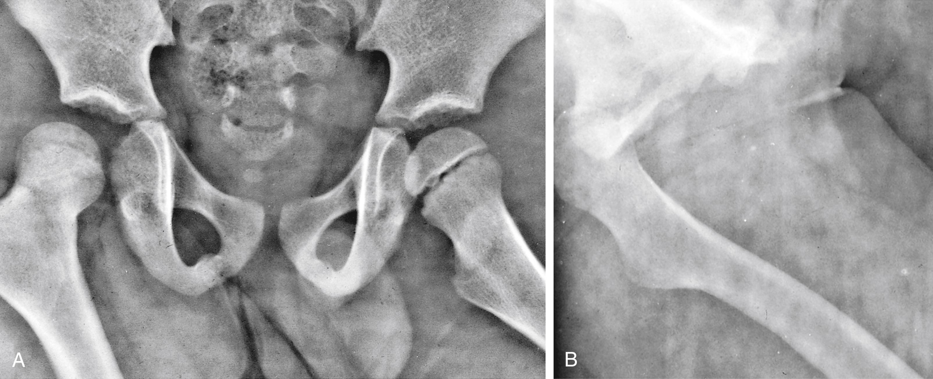 Fig. 22.58, Traumatic posterior hip dislocation. This child suffered an impaction injury in an automobile accident. (A) In the anteroposterior view, the right femoral head appears to be displaced laterally and superiorly. The femur is also adducted and internally rotated. (B) The frog-leg view discloses the severity of displacement posteriorly.