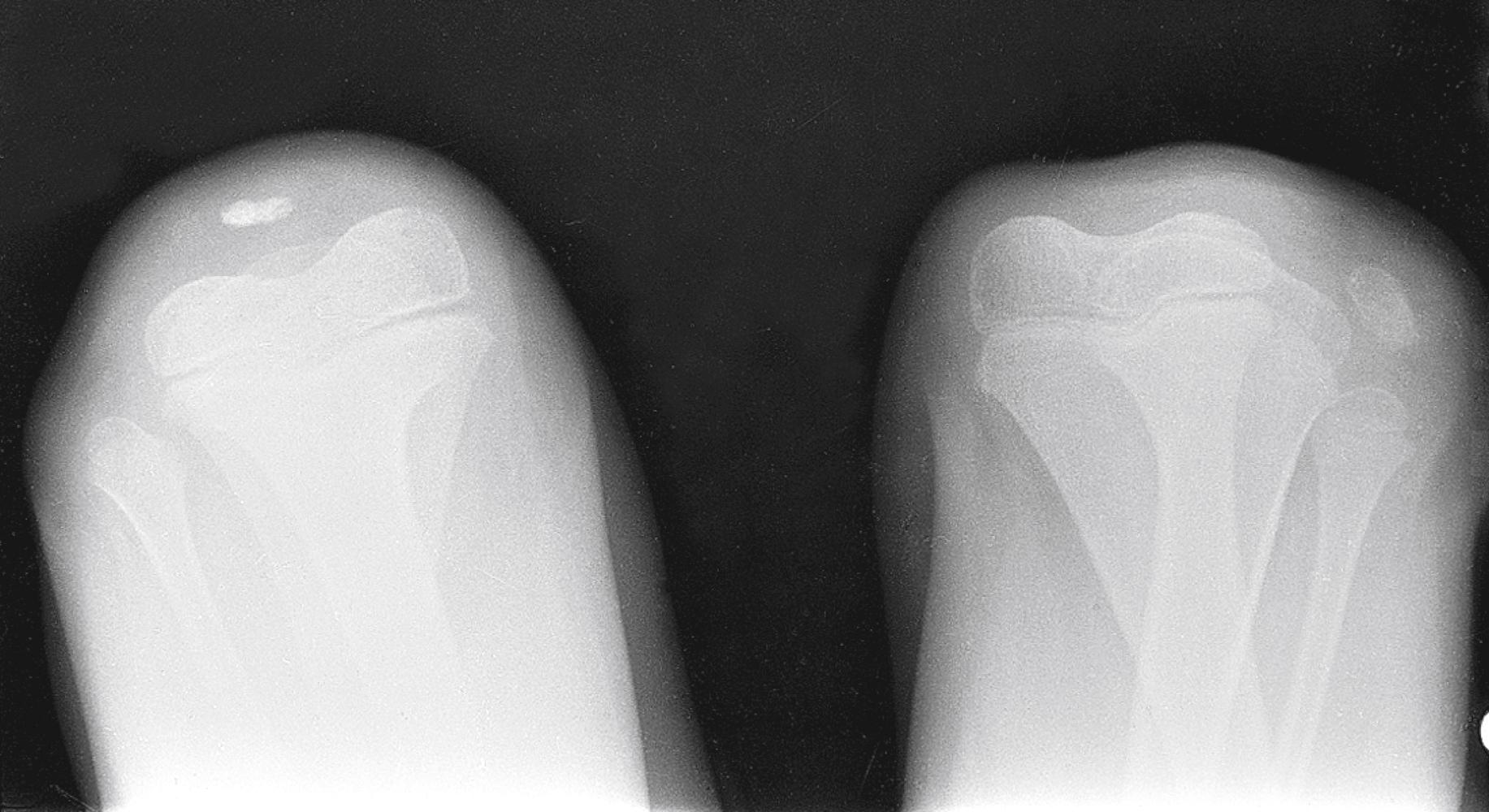 Fig. 22.59, Patellar dislocation. In this flexion view obtained before relocation, the left patella is displaced laterally and there is marked swelling.