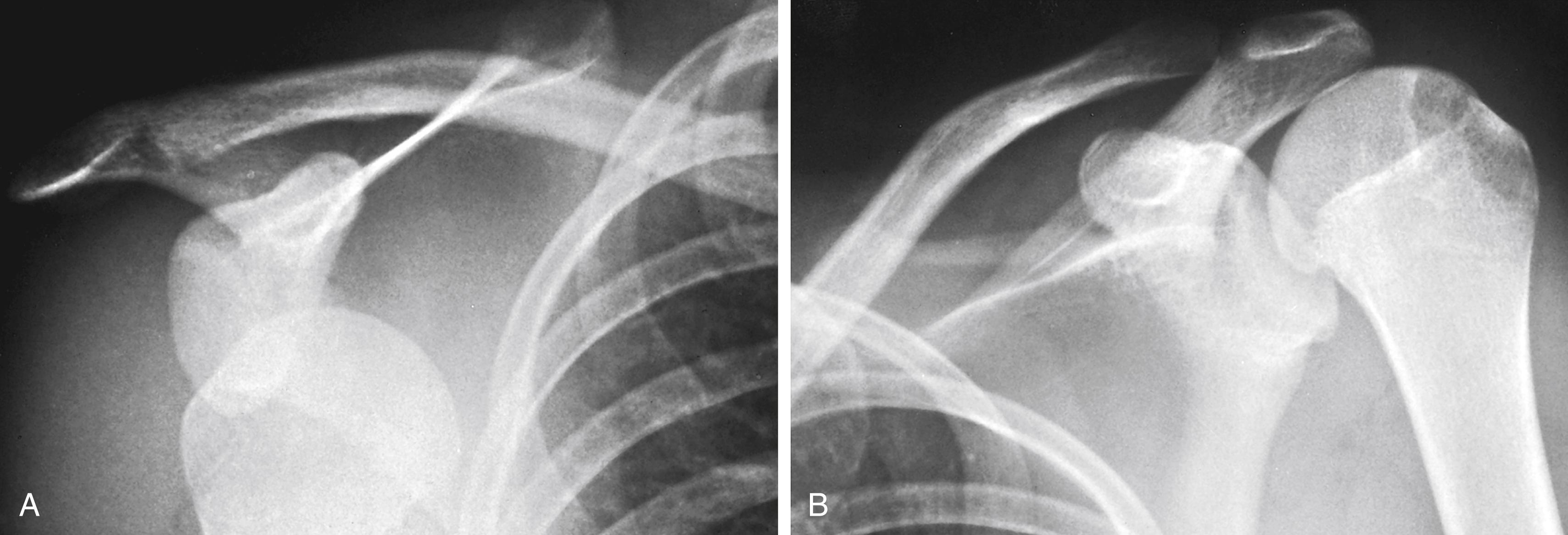 Fig. 22.60, (A) Anterior dislocation of the right shoulder. The humeral head is not in the glenoid fossa but is displaced anteriorly. (B) The normal relationship is seen in this comparison view of the left shoulder. The injury occurred when the patient was taking a back swing for a hockey shot. The patient felt a pop with the immediate onset of severe pain. Note that his epiphyses have fused.