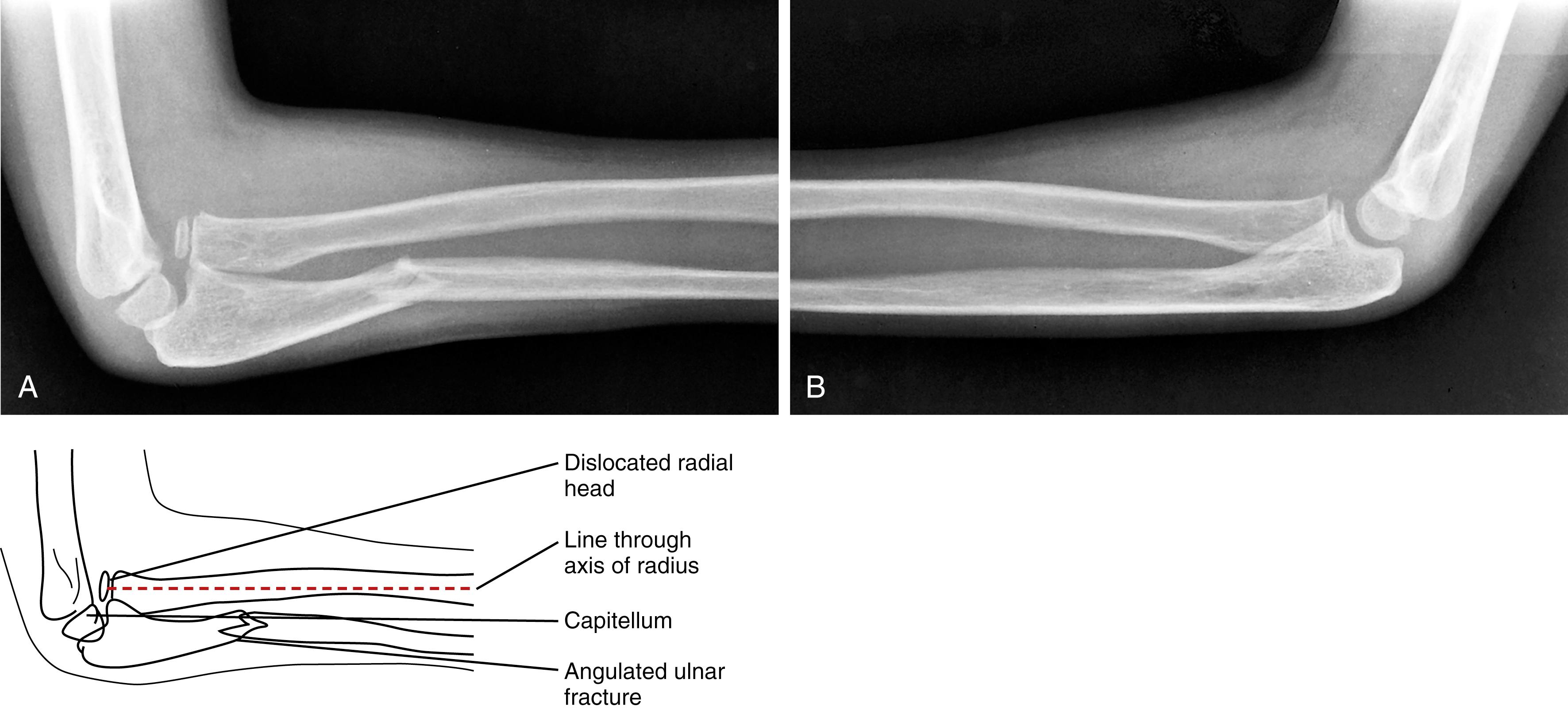 Fig. 22.61, Monteggia fracture. (A) A displaced fracture of the proximal right ulna is accompanied by dislocation of the radial head. A line drawn through the long axis of the radius would intersect the distal humerus above the level of the capitellum. (B) The comparison view of the left arm shows the normal position of the radial head.