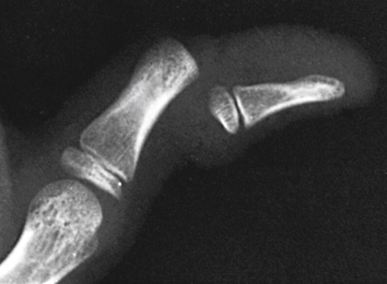 Fig. 22.62, Interphalangeal joint dislocation. The distal phalanx of the thumb is dislocated dorsally.