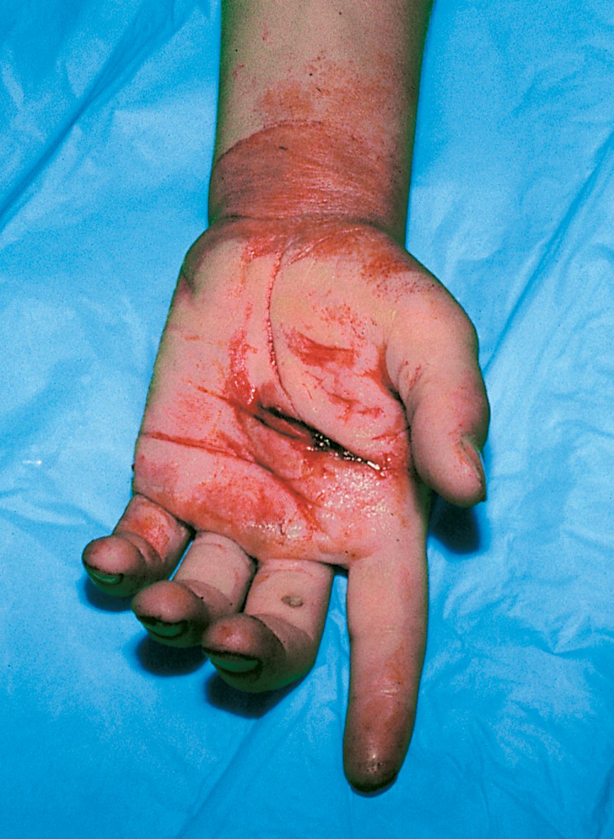 Fig. 22.7, Extensor tendon overpull. This boy’s palm laceration involved the flexor tendons to his index finger. With his hand at rest, his index finger lies in extension, in contrast to his other fingers, which are partially flexed.