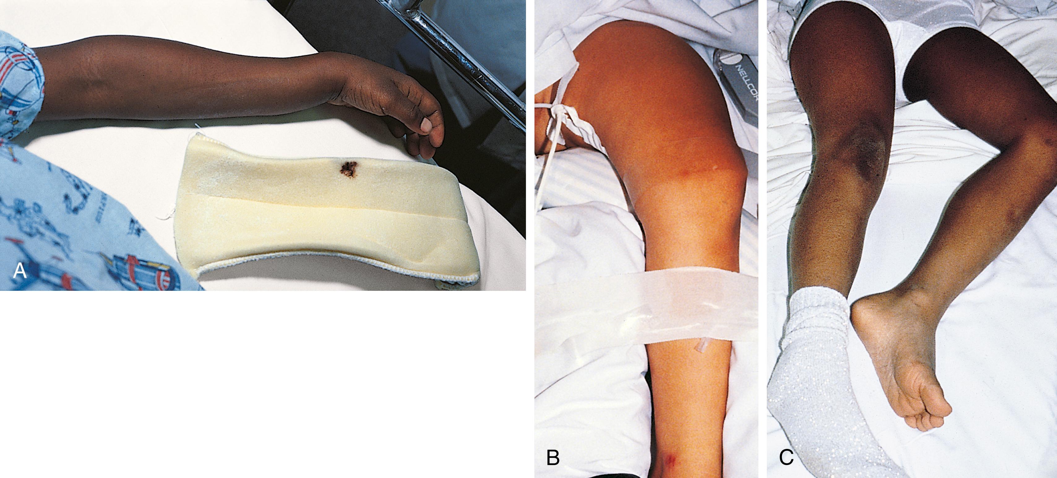 Fig. 22.15, Visible abnormalities seen on inspection in children with fractures. (A) Distortion and angulation of the distal forearm in a child with fractures of the radius and ulna. (B) Swelling and angulation of the proximal thigh resulting from a femur fracture. (C) Longitudinal shortening of the thigh in a child with a proximal femur fracture. Note the characteristic externally rotated position of the injured leg. The child was struck by a car, sustaining a fracture of the femoral neck.