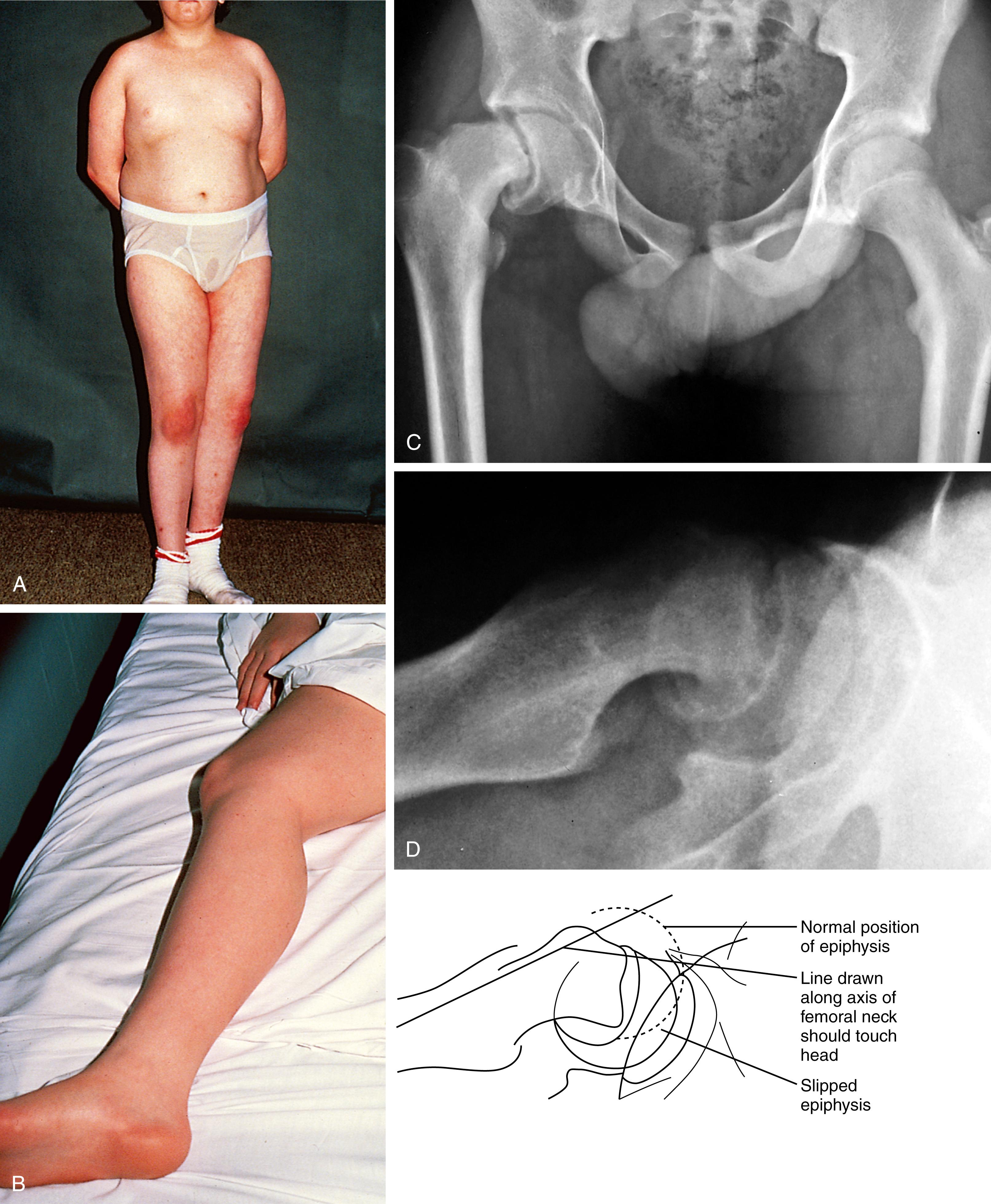 Fig. 22.91, Slipped capital femoral epiphysis. (A) This obese boy presented with a painful limp during early puberty. Note his reluctance to bear weight on the involved right leg. (B) When he lies supine, the affected leg is positioned in external rotation because this minimizes discomfort. Attempts at motion produce pain in the acutely slipped epiphysis. (C) In the anteroposterior radiograph, the right femoral head is displaced medially in relation to the femoral neck as a result of epiphyseal separation. (D) In the lateral view, the femoral head is seen to be displaced posteriorly in relation to the femoral neck. A line drawn along the axis of the femoral neck should normally touch the head.