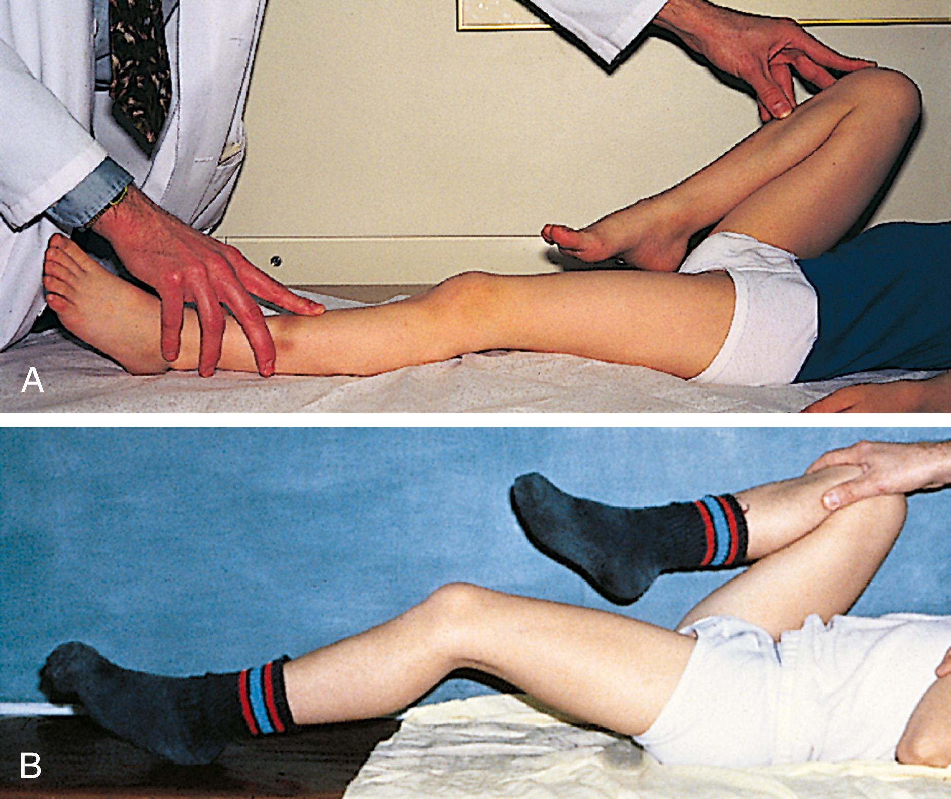 Fig. 22.8, Thomas test. This test of range of hip extension is performed by flexing both hips, then holding one in flexion while the patient is asked to extend the other leg. (A) Normally, full extension is achieved. (B) Inability to fully extend the hip, seen in this boy with Legg-Calvé-Perthes disease, indicates the presence of a flexion contracture of the hip and constitutes a positive Thomas test.