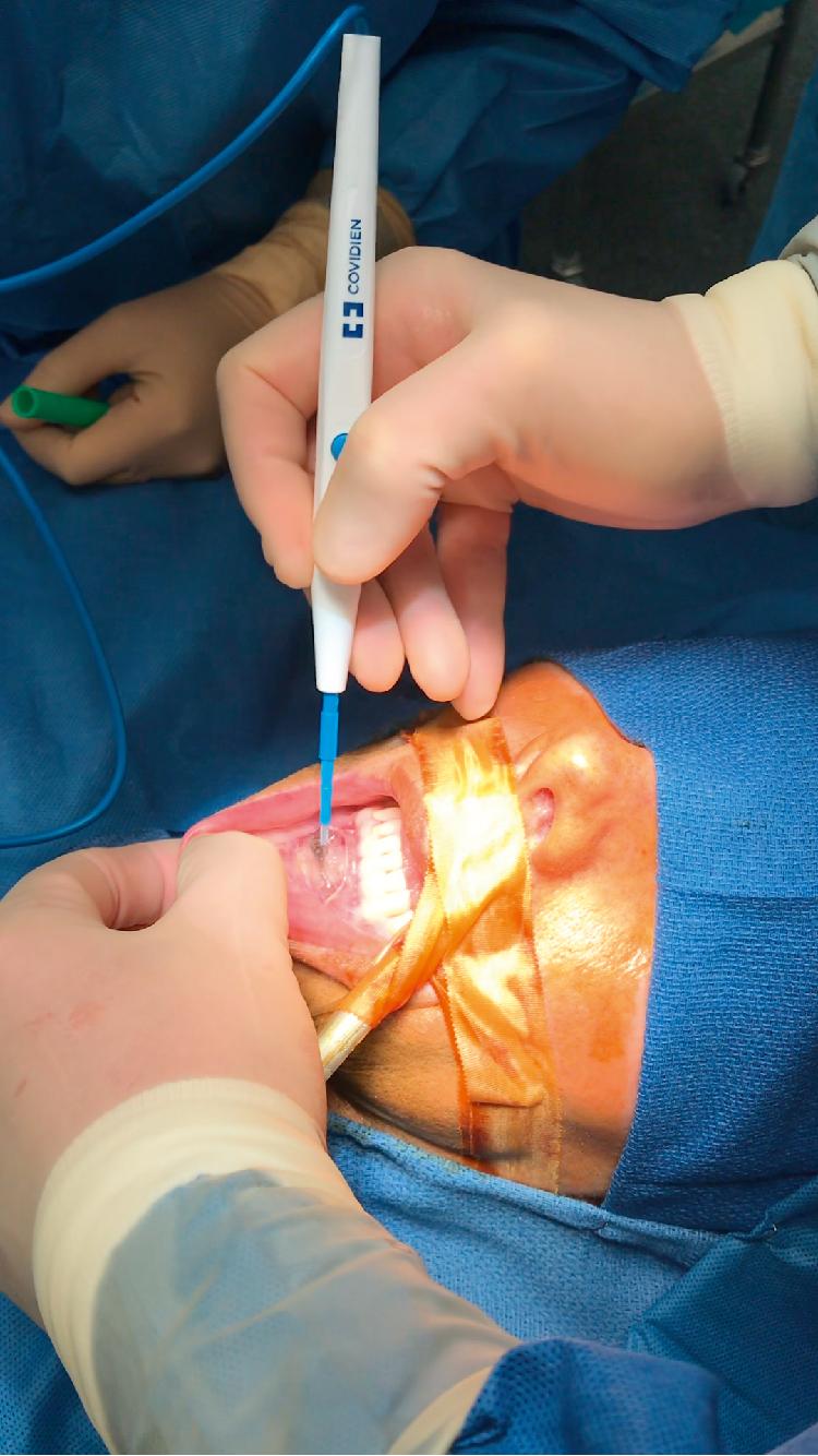 Fig. 27.1, The lip is everted, and the nondominant index finger is placed under the everted lip to palpate the electrocautery tip and to ensure that the surgeon does not inadvertently buttonhole the incision.