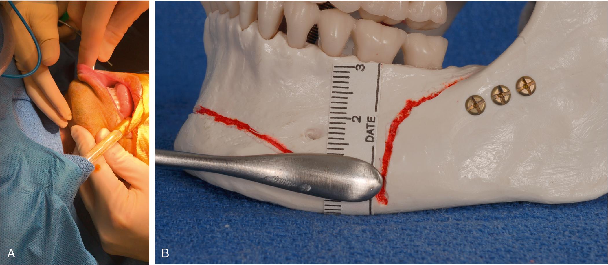 Fig. 27.2, (A) The Obwegeser periosteal elevator is placed such that the edge is adjacent to the inferior border of the mandible. The location is confirmed by palpation, and the surgeon can advance the elevator laterally in a subperiosteal plane to dissect the pocket rapidly. As long as the elevator’s inferior edge is congruent with the inferior border of the mandible, there is little risk of injuring the nerve, and the dissection can be done blindly. (B) The widest of the Obwegeser periosteal elevators is 10 mm. The distance from the inferior border of the mandible to the mental foramina has been shown to be 14.61 mm. Given that there is a 5-mm safety margin, a rapid blind subperiosteal dissection can be performed as long as the edge of the elevator hugs the inferior edge of the mandible.