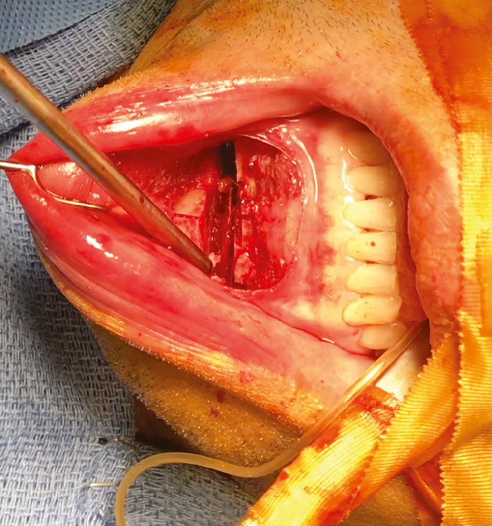 Fig. 27.5, Once the chin has been released, it is mobile and can easily be placed in its desired position. It is important in most genioplasties to maintain the soft tissue attachment to the genial tubercle. The stretching of this tissue is important in achieving an optimal soft tissue response to the procedure.