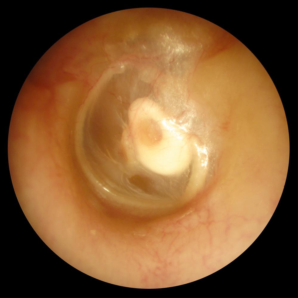 Fig. 132.2, Hydroxyapatite partial ossicular replacement prosthesis making direct contact with the tympanic membrane. Note the very slight tenting over the prosthesis.