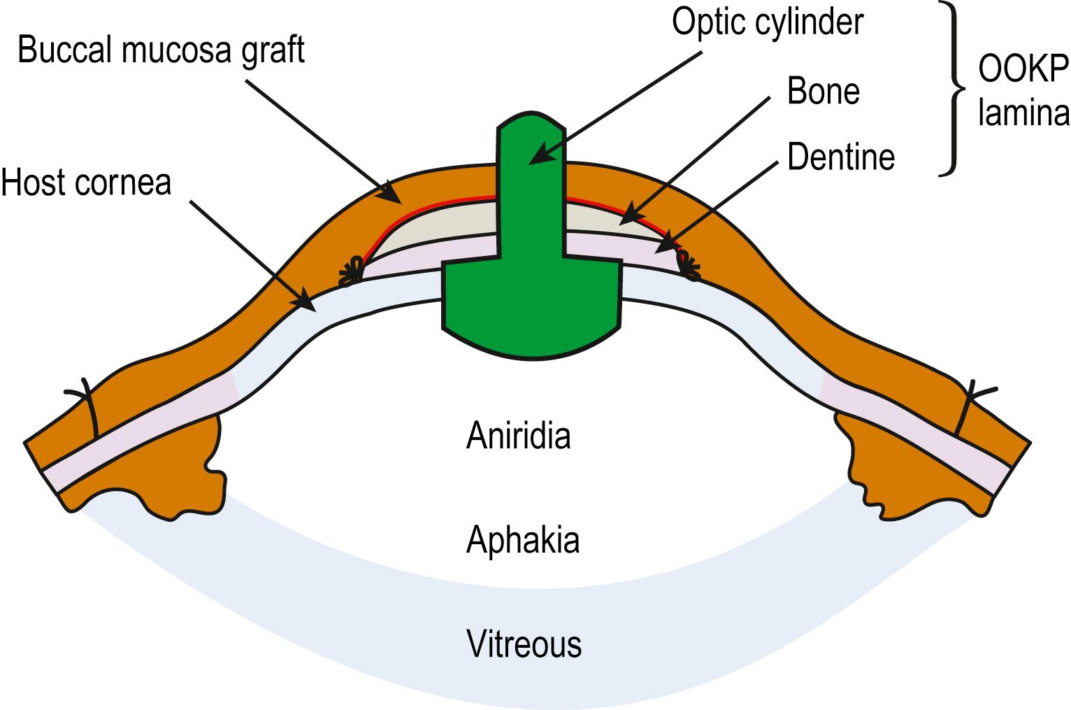 Fig. 161.1, Schematic representation of osteo-odonto-keratoprosthesis (OOKP) demonstrating the relationship of the buccal mucosa, OOKP lamina, and cornea.