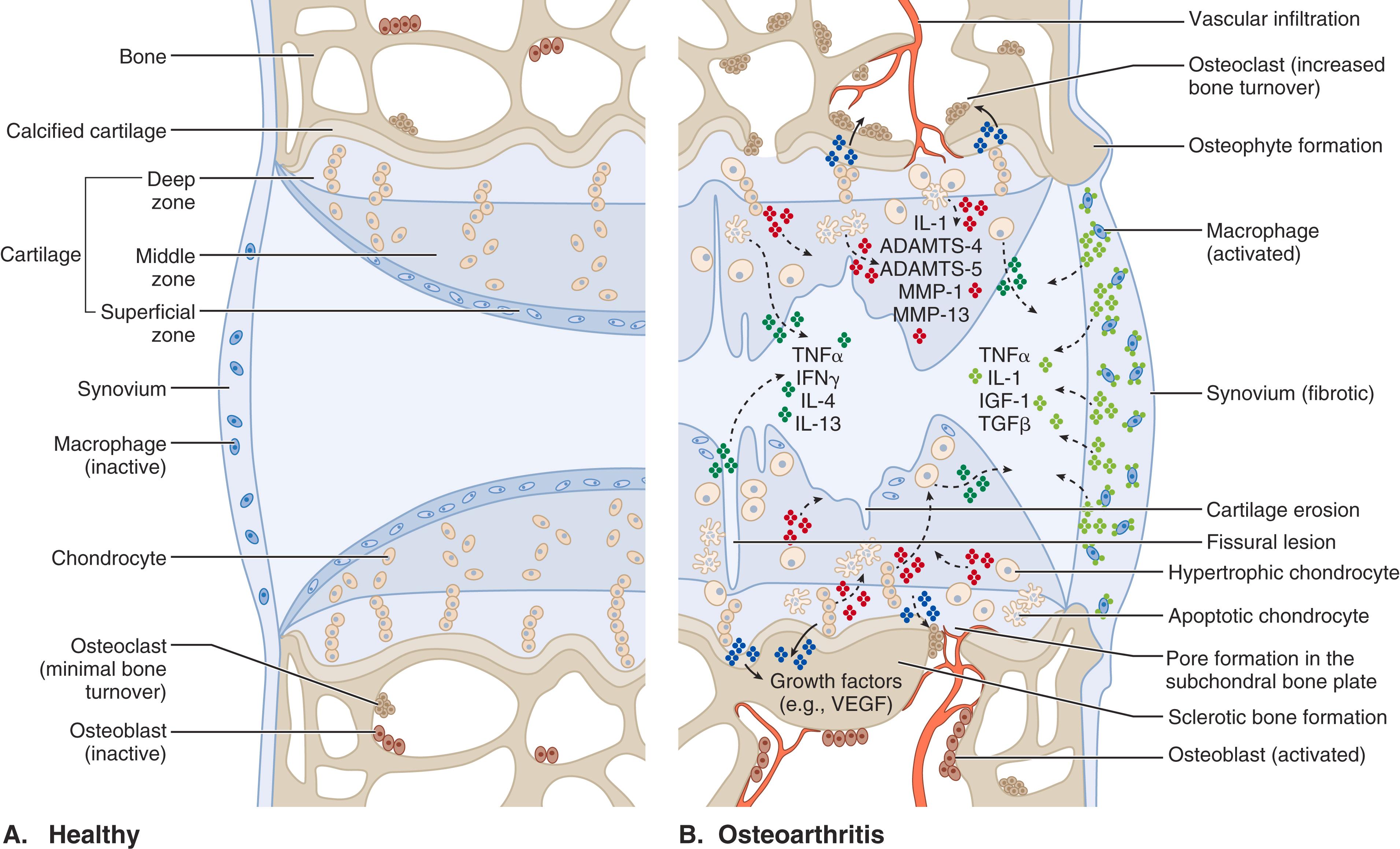 E-FIGURE 241-1, Signaling pathways and structural changes in the development of osteoarthritis.