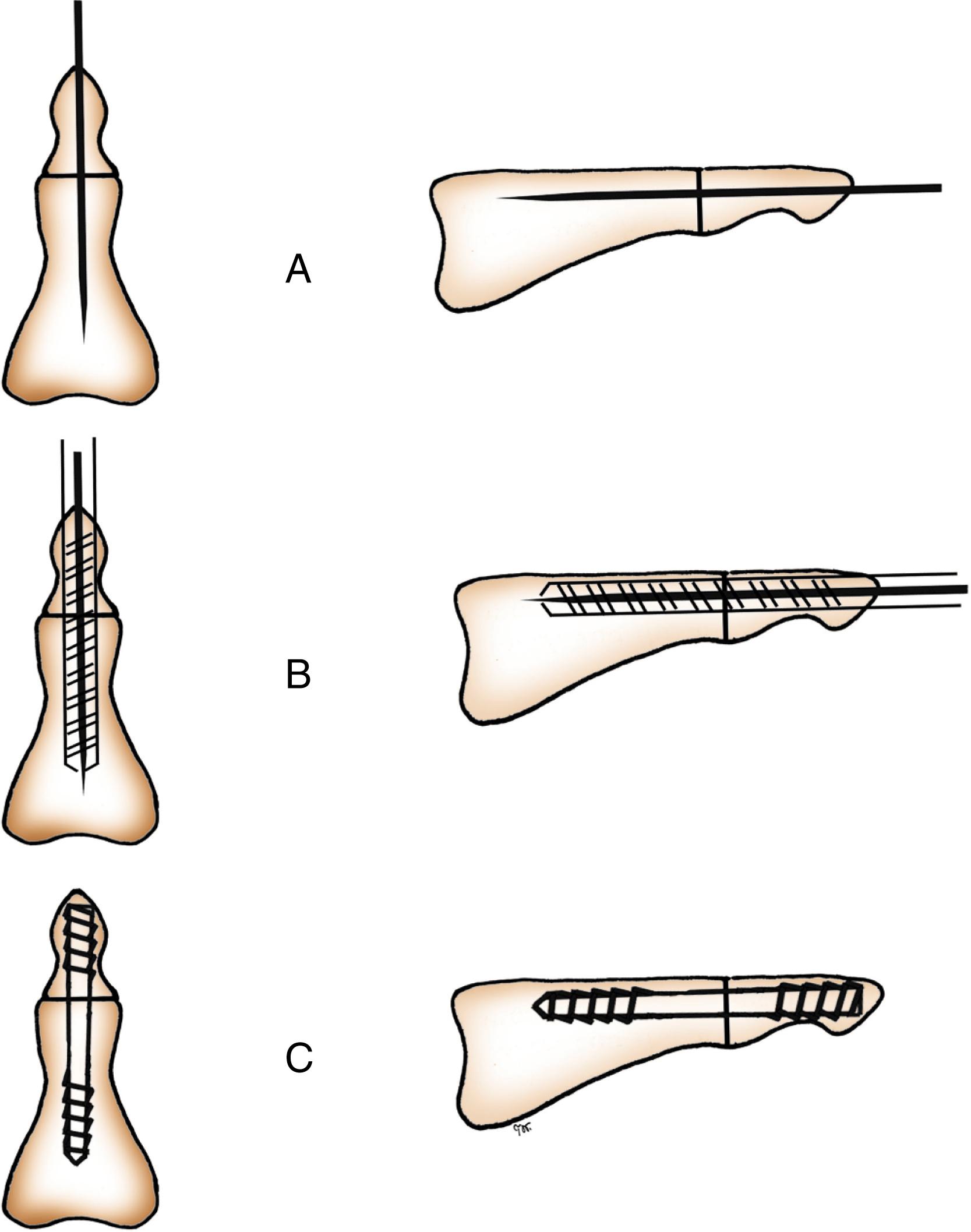 Fig. 57.1, (A–C) Distal interphalangeal joint arthrodesis