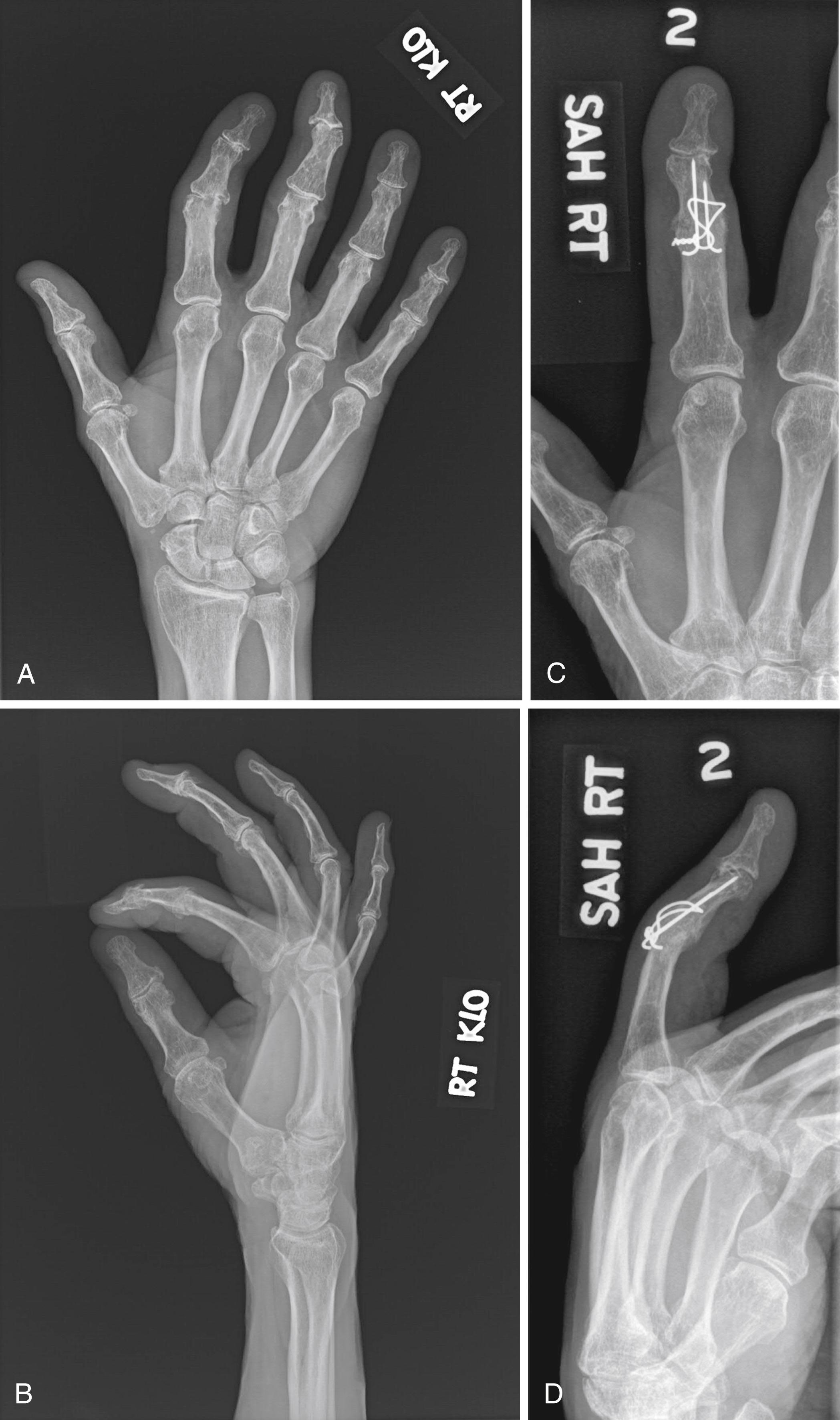 Fig. 57.2, (A–D) Proximal interphalangeal joint arthrodesis.