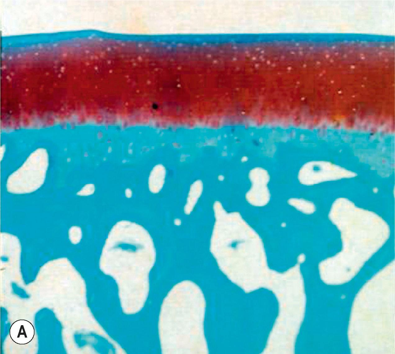 Figure 18.1, Histological section of (A) normal and (B) abnormal cartilage. In the (A) normal joint, articular cartilage is connected to the bone through a layer of calcified cartilage. The tidemark histologically separates the articular cartilage from calcified cartilage. The calcified cartilage receives nutrients through the epiphyseal vessel; the articular cartilage receives nutrients primarily through diffusion from the overlying joint fluid. (B) In joints affected by OA there is fraying in the superficial cartilage and decrease in articular cartilage thickness.