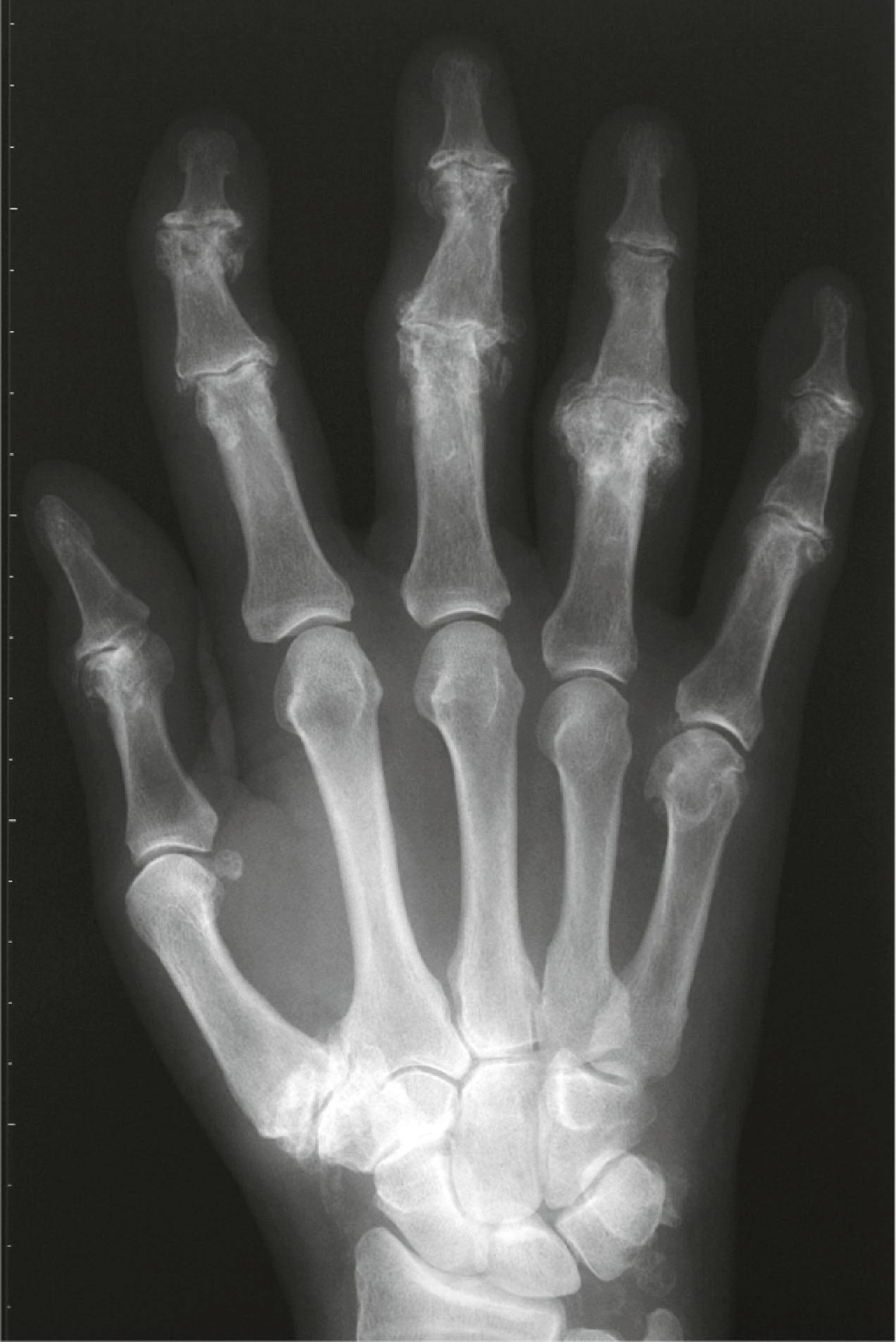 Figure 18.2, PA radiograph of the hand of a 69-year-old male showing typical bony changes seen in advanced OA. Osteophyte formation is seen at the DIP and PIP joints and the trapeziometacarpal joint of the thumb. Joint narrowing is seen within the fingers as well as evidence of subchondral sclerosis.