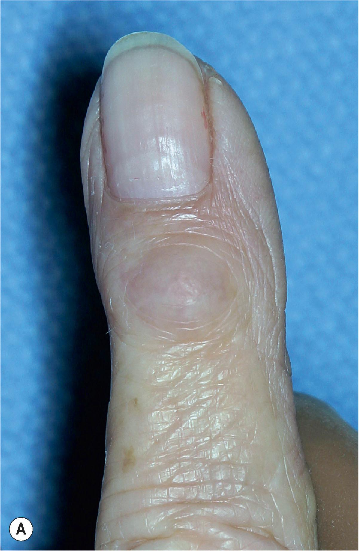 Figure 18.3, Typical appearance of a mucous cyst in this 67-year-old female with DIP OA. (A) A mass is palpable over the joint. (B) The cyst is clearly seen at the time of surgical exploration. (C) Mucous cysts may also present with nail grooving, which results from pressure on the germinal and sterile matrix of the nail.