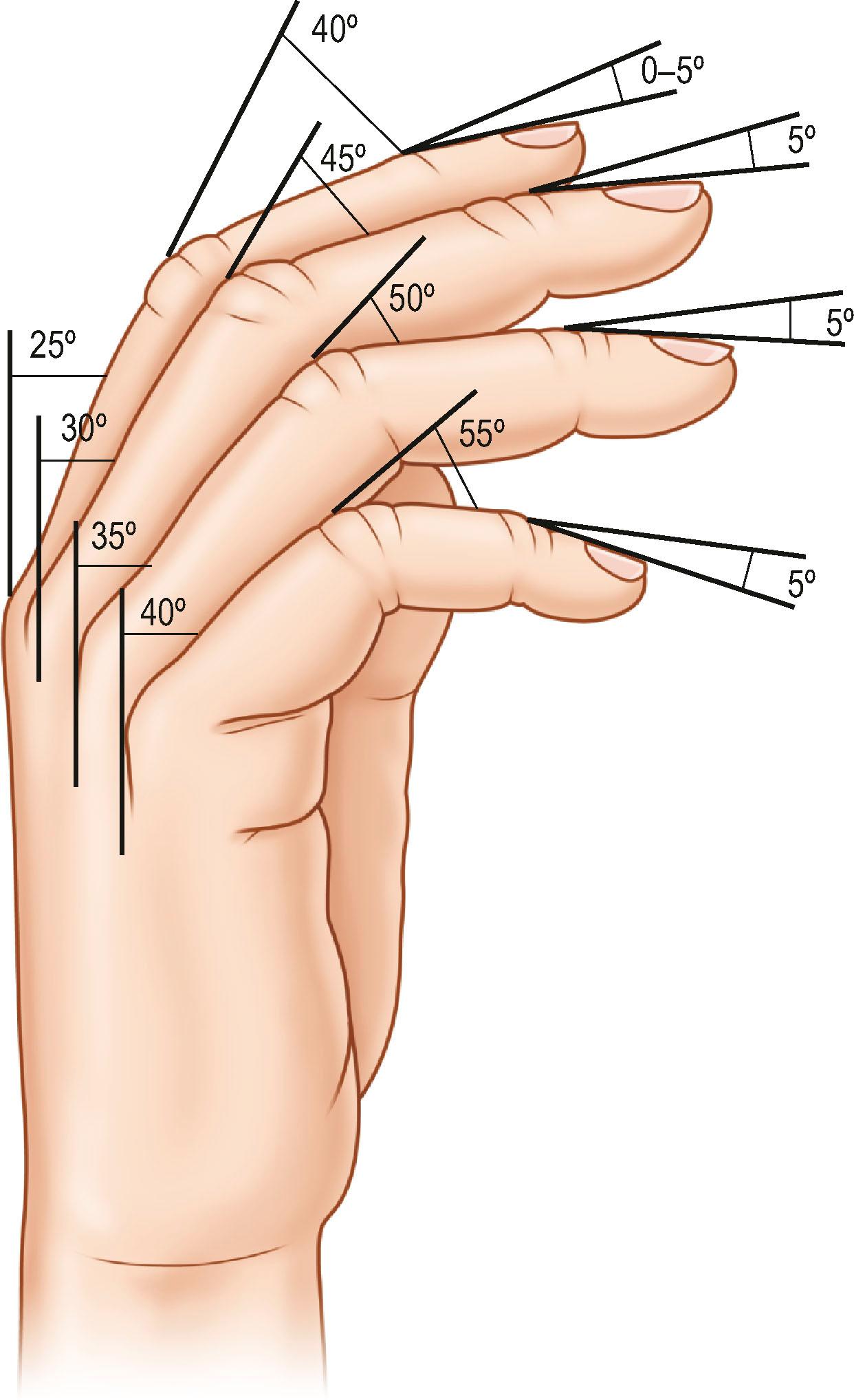 Figure 18.5, Illustration of recommended fusion angles for DIP, PIP, and MCP joints. DIP fusion angles are often performed with 0–15° of flexion. PIP fusion angles increase as one moves from the index to the small finger, to correspond with the natural cascade of the hand. Recommended fusion angles for the PIP joint have been 40° of flexion for the index, 45° for the long, 50° of flexion for the ring and 55° of flexion for the small finger. MCP fusion angles have been recommended to progress from 25° of flexion at the index to 40° of flexion at the small finger.