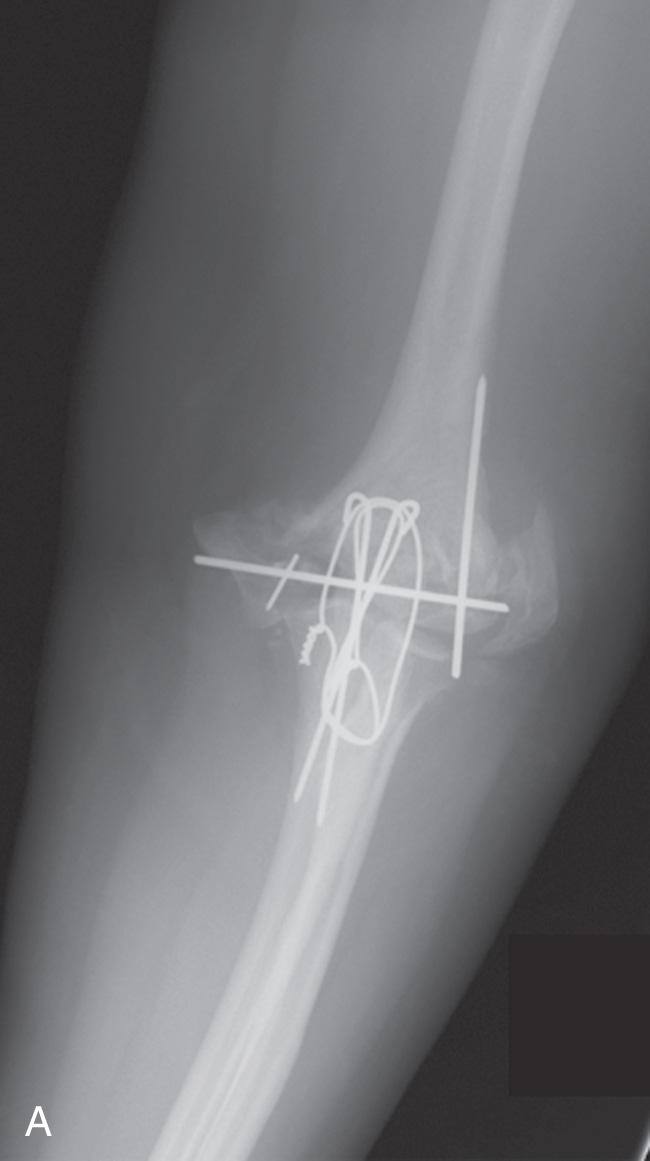 FIG 112.1, The instances in which there is loss of articular surface and bone but maintenance of collateral origins (A) allows a prosthetic hemireplacement (B).