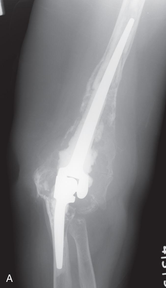 FIG 112.2, A 44-year-old patient with gross osteolysis secondary to a nickel allergy (A,B). A resection of the joint and allograft elbow replacement at 12 years reveals some neutrophic changes but remains stable and functional (C,D).