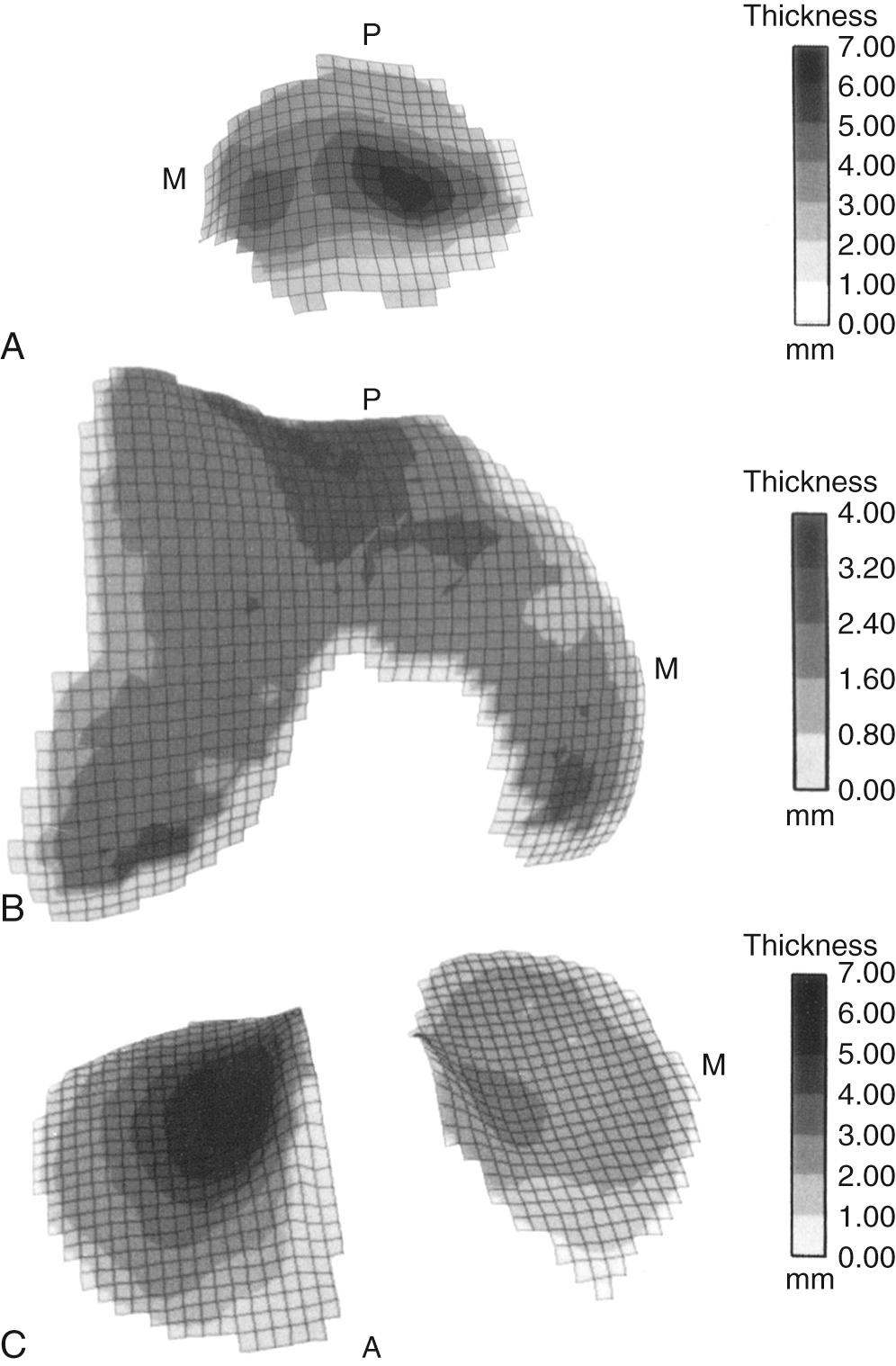 FIG 30.1, Grayscale of cartilage thickness superimposed on the topographic map of (A) patellar, (B) femoral, and (C) tibial articular surfaces. A, Anterior; M , medial; P, proximal.