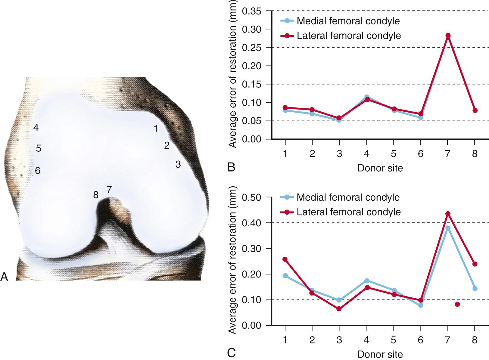 FIG 30.2, Surface topography measurements and calculations of topographic mismatch to a central weight-bearing defect in the medial femoral condyle for the eight most common OAT donor sites (A). (B) Average errors of restoration of surface topography for a 6 mm defect with osteochondral autograft plugs from each of the regions in (A). (C) Average errors of restoration of surface topography for an 8 mm defect.