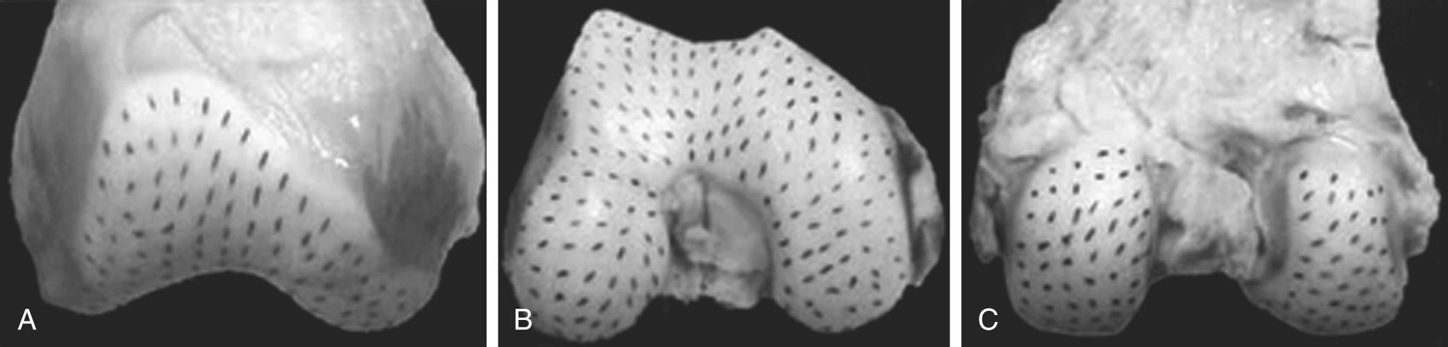 FIG 30.3, Split Line Pattern of the Distal Femur