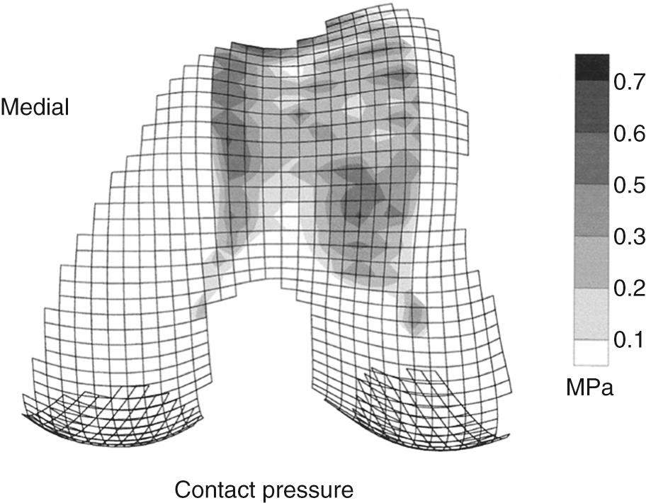 FIG 30.4, Grayscale of typical patellofemoral contact pressures superimposed on the topographic map of the distal femur.