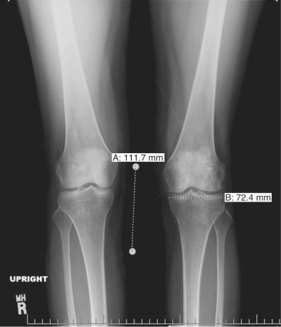 FIG 32-1, Anteroposterior radiograph of bilateral knees in a 44-year-old patient with osteonecrotic changes to her left lateral femoral condyle, displaying a tibial measurement and a radiographic magnification marker for allograft sizing.