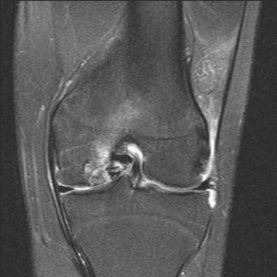 FIG 32-2, T2 sequence magnetic resonance imaging of the left knee of an 18-year-old woman demonstrates an osteochondritis dissecans lesion in typical location on the lateral aspect of the left medial femoral condyle.