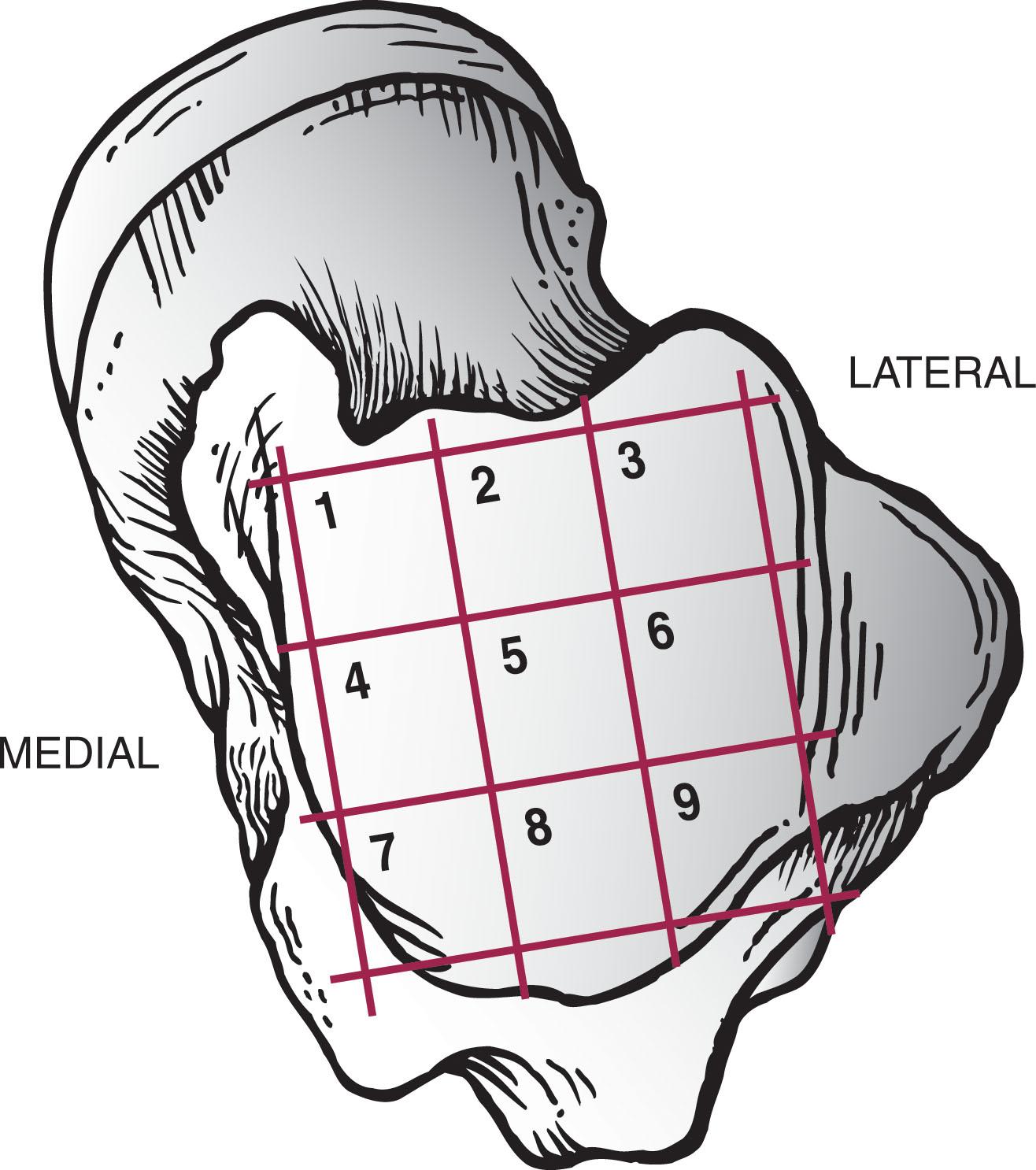 Fig. 40-1, Axial grid of talus helps localize osteochondral lesion of the talus. The most common sites were zone 4, mid-medial, followed by zone 6, mid-lateral.