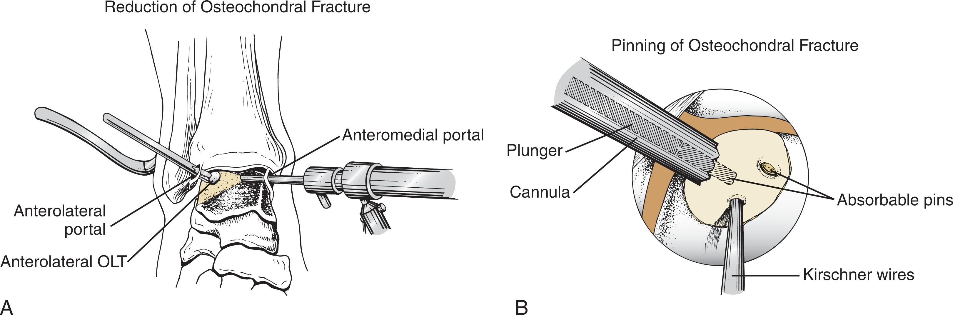 Fig. 40-12, Internal fixation of an osteochondral lesion of lateral talar dome. A , A clamp or other device is inserted to reduce the acute fracture to its fracture bed on the lateral talar dome. B , The acute osteochondral fracture is provisionally held with a small K-wires and internally fixed with absorbable pins. OLT , Osteochondral lesion of the talus.