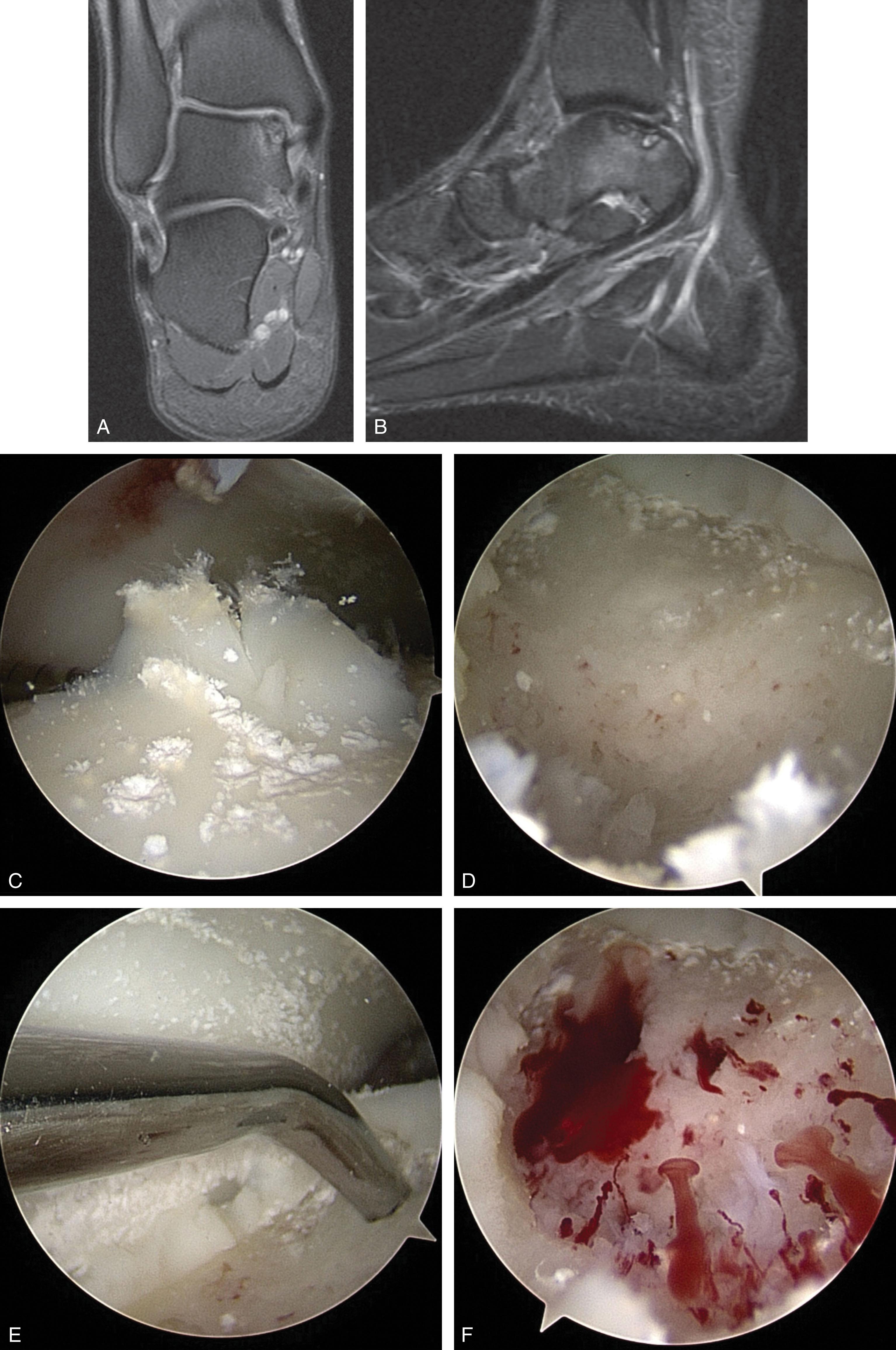 Fig. 40-14, Arthroscopic microfracture technique for osteochondral lesions of the talus. A and B , MRI scans showing a Hepple Stage IIB medial talar dome osteochondral lesion. C , Arthroscopic view of the medial talus through the anterolateral portal showing partial elevation of the talar dome cartilage surface with an intact base (Ferkel Grade D). D , Arthroscopic view after debridement. E , Microfracture awl shown penetrating the subchondral bone. F , Tourniquet and fluid pressure are reduced to visualize bleeding from the subchondral bone through the microfracture holes.