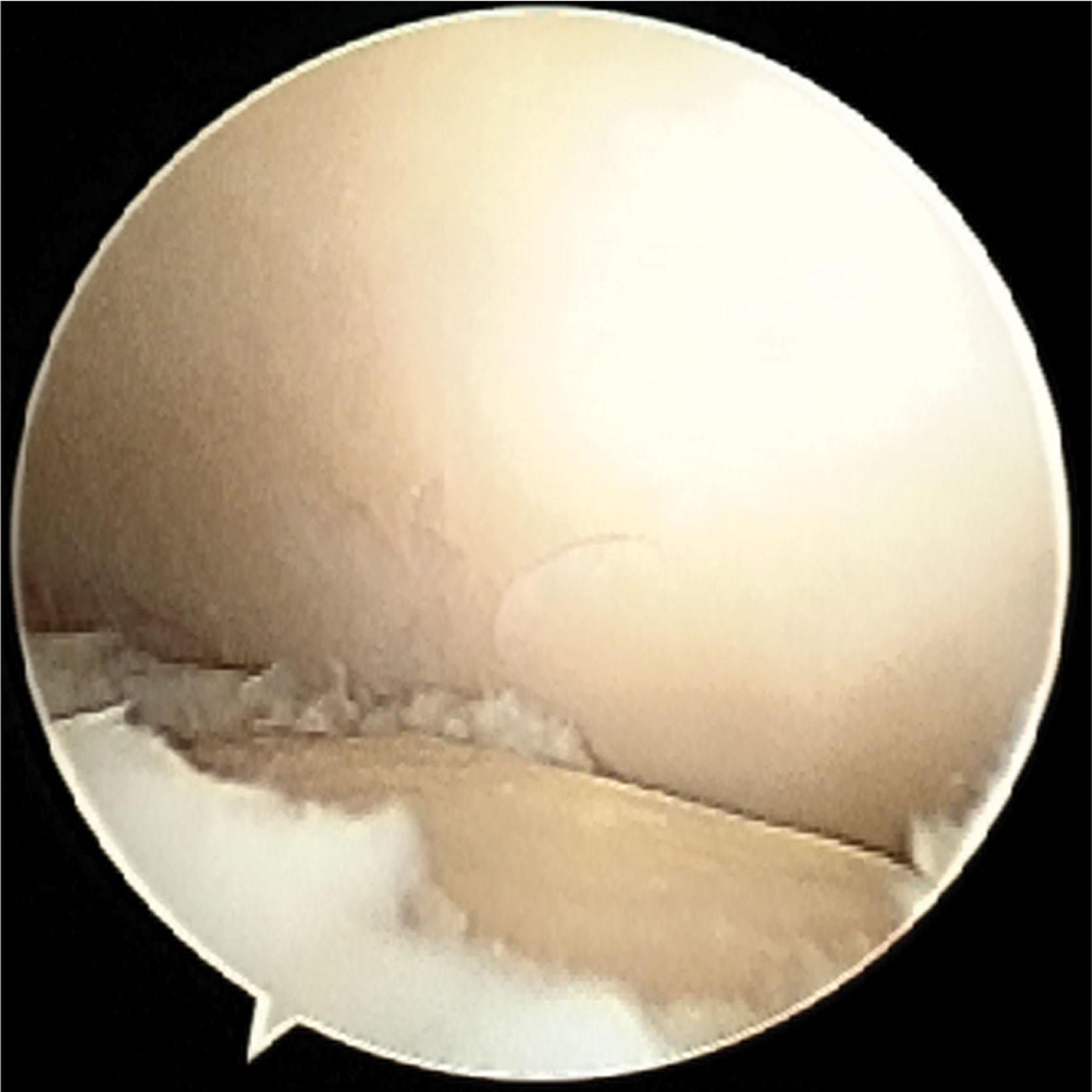 Fig. 40-15, View from the anterolateral portal showing an osteochondral flap lesion with intact subchondral bone (Grade D) after debridement of loose and damaged cartilage, leaving vertical, stable cartilage edges. This lesion involves the medial shoulder of the talus making it an uncontained defect.