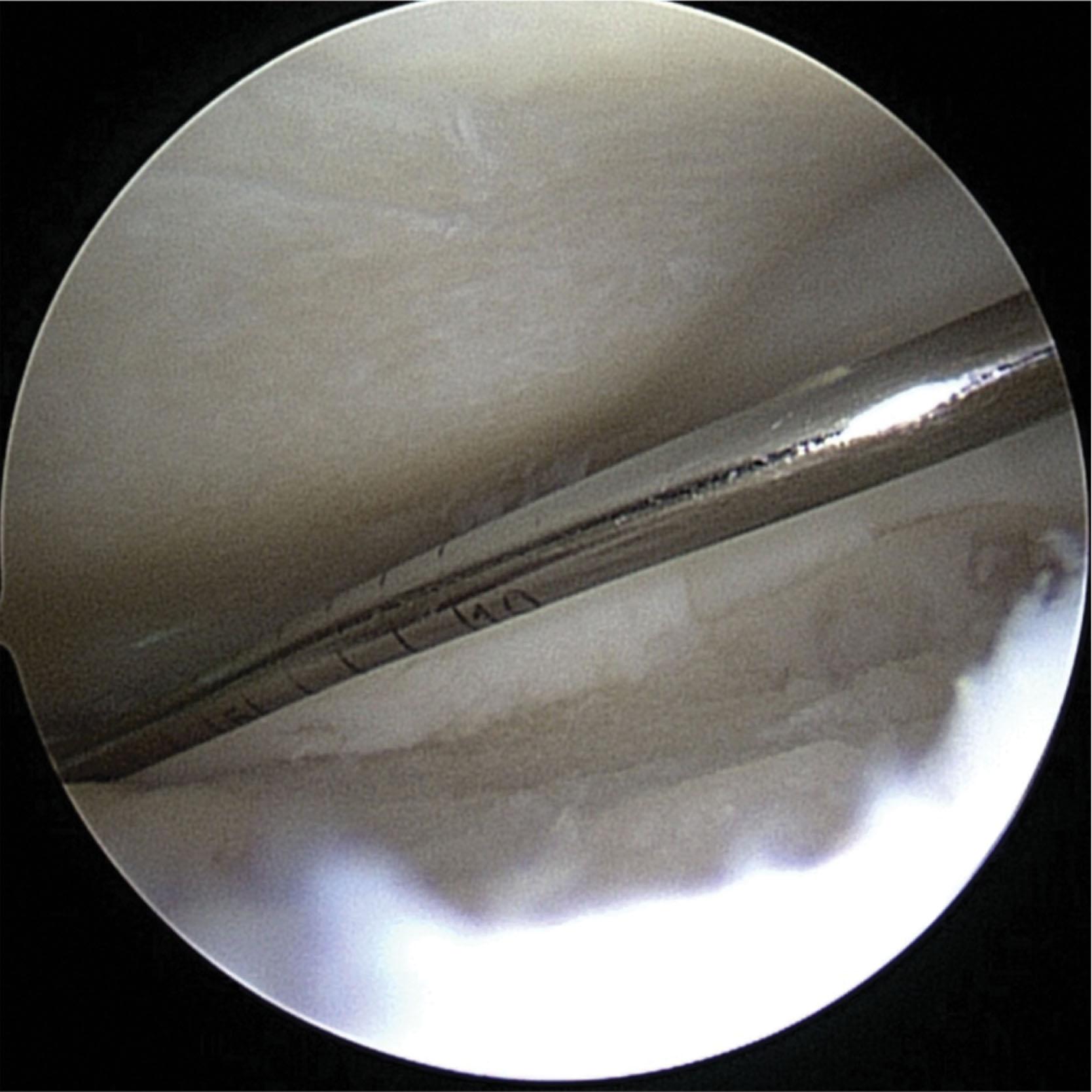 Fig. 40-16, The width, length, and depth of the osteochondral lesion are measured using a graduated probe.