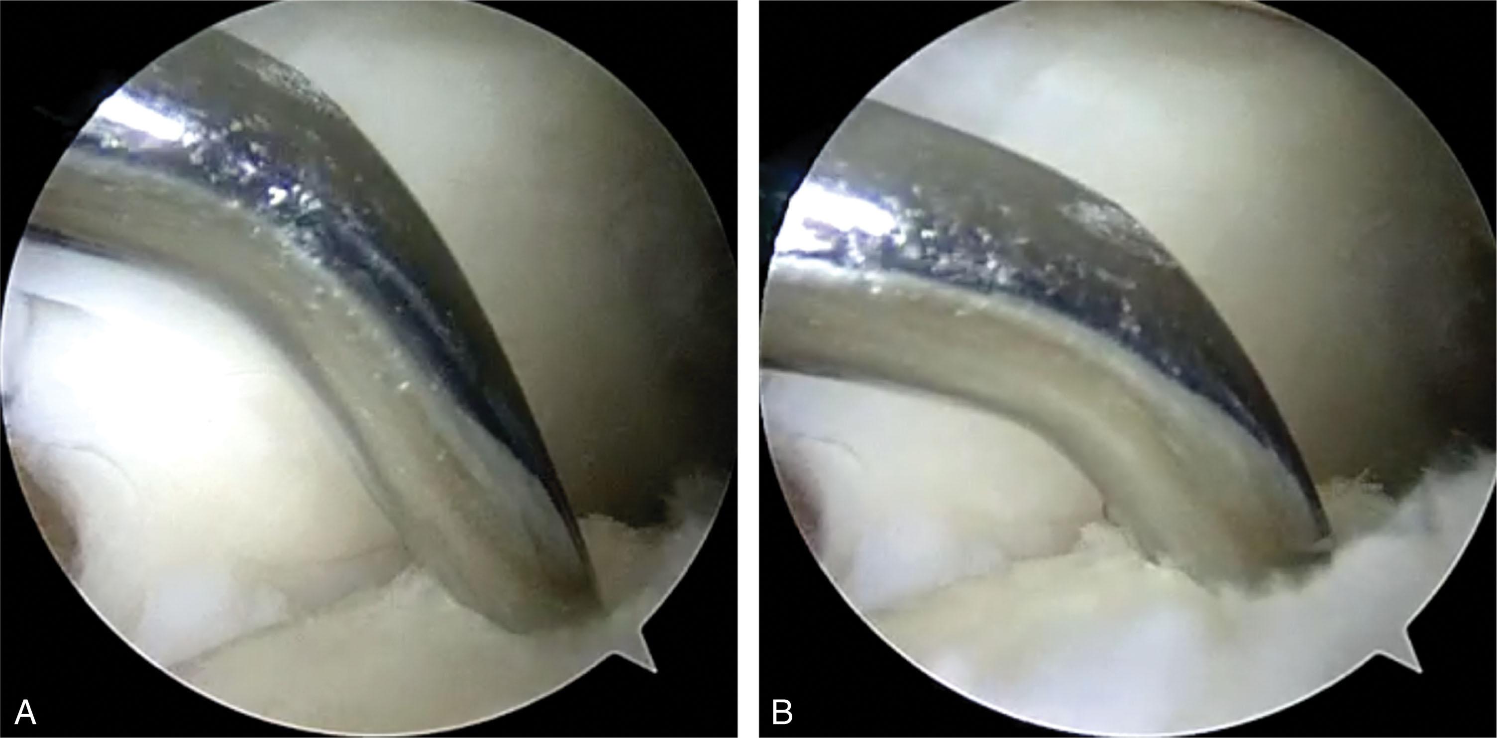 Fig. 40-17, View from the anteromedial portal showing a microfracture awl penetrating the subchondral bone of a lateral talar dome osteochondral defect. A , The awl begins to penetrate the subchondral bone. B , The awl has penetrated about 8 mm into the talar body.