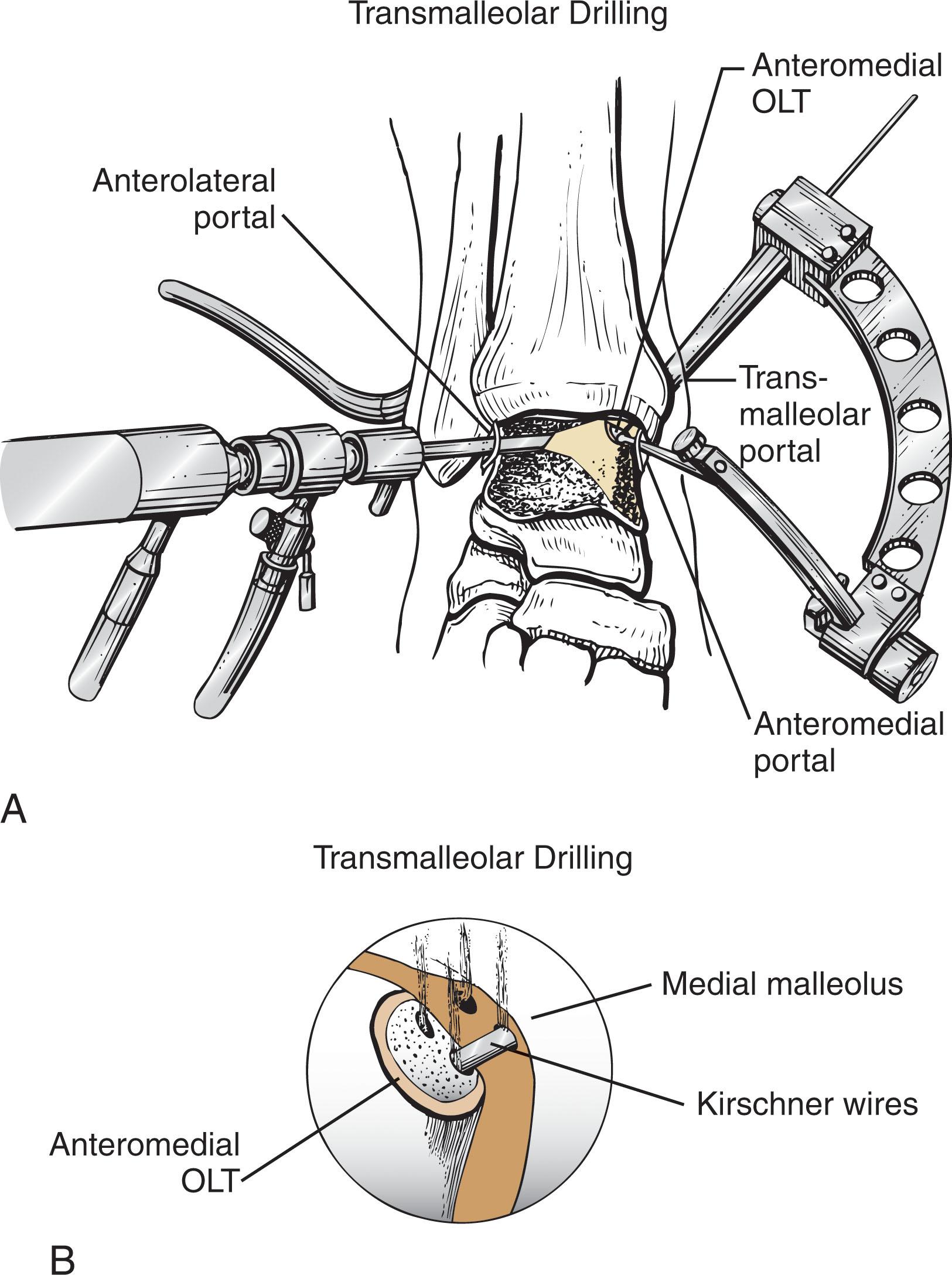 Fig. 40-18, A , Transmalleolar drilling of the osteochondral lesion of the medial dome of the talus using the Micro Vector drill guide. Visualization is through the anterolateral portal, and inflow is placed through the posterolateral portal. B , Drill holes are established through the medial malleolus into the talus down to areas of bleeding bone.