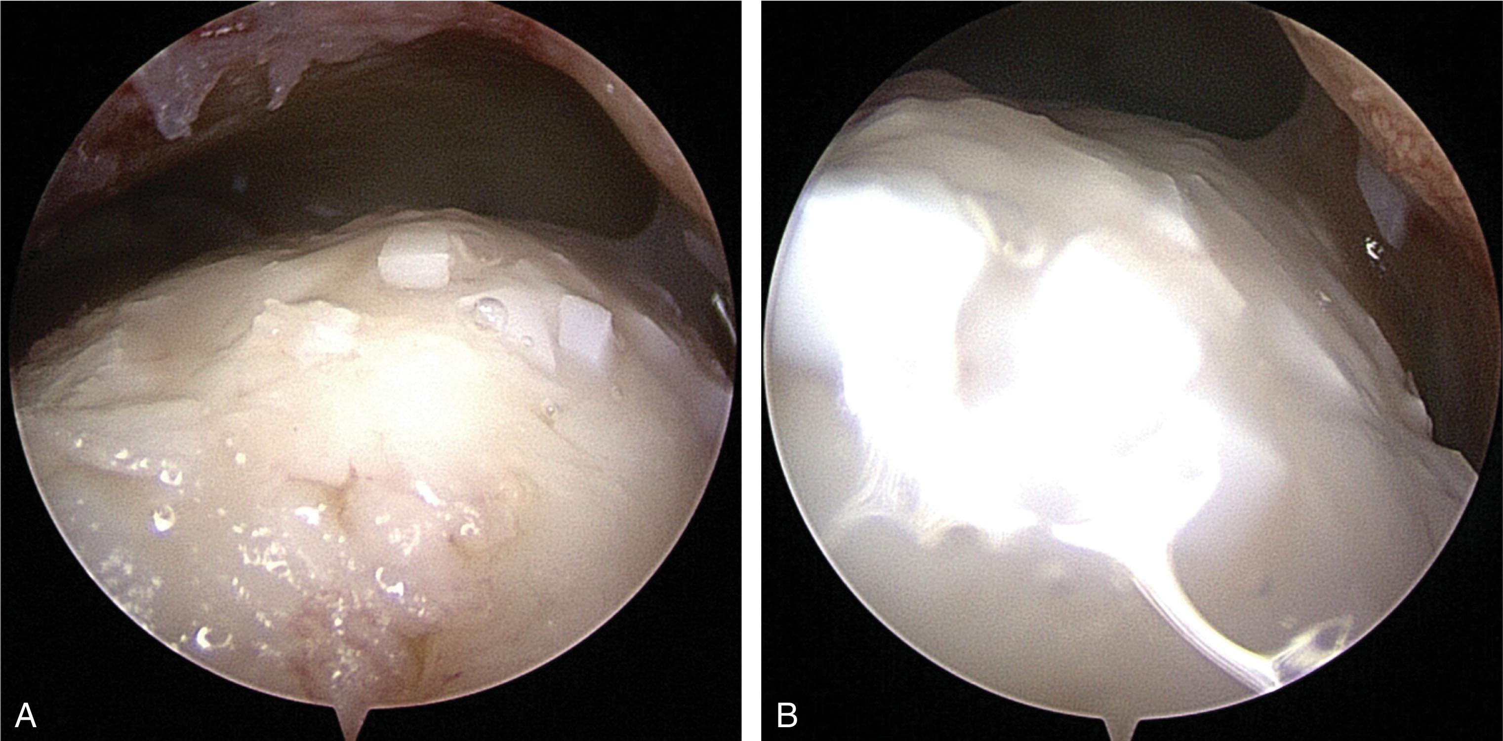 Fig. 40-19, Juvenile particulated allograft cartilage. A , Morselized allograft chondrocytes plus extracellular matrix are applied to a prepared osteochondral lesion. B , Fibrin glue is applied to secure the allograft in position.