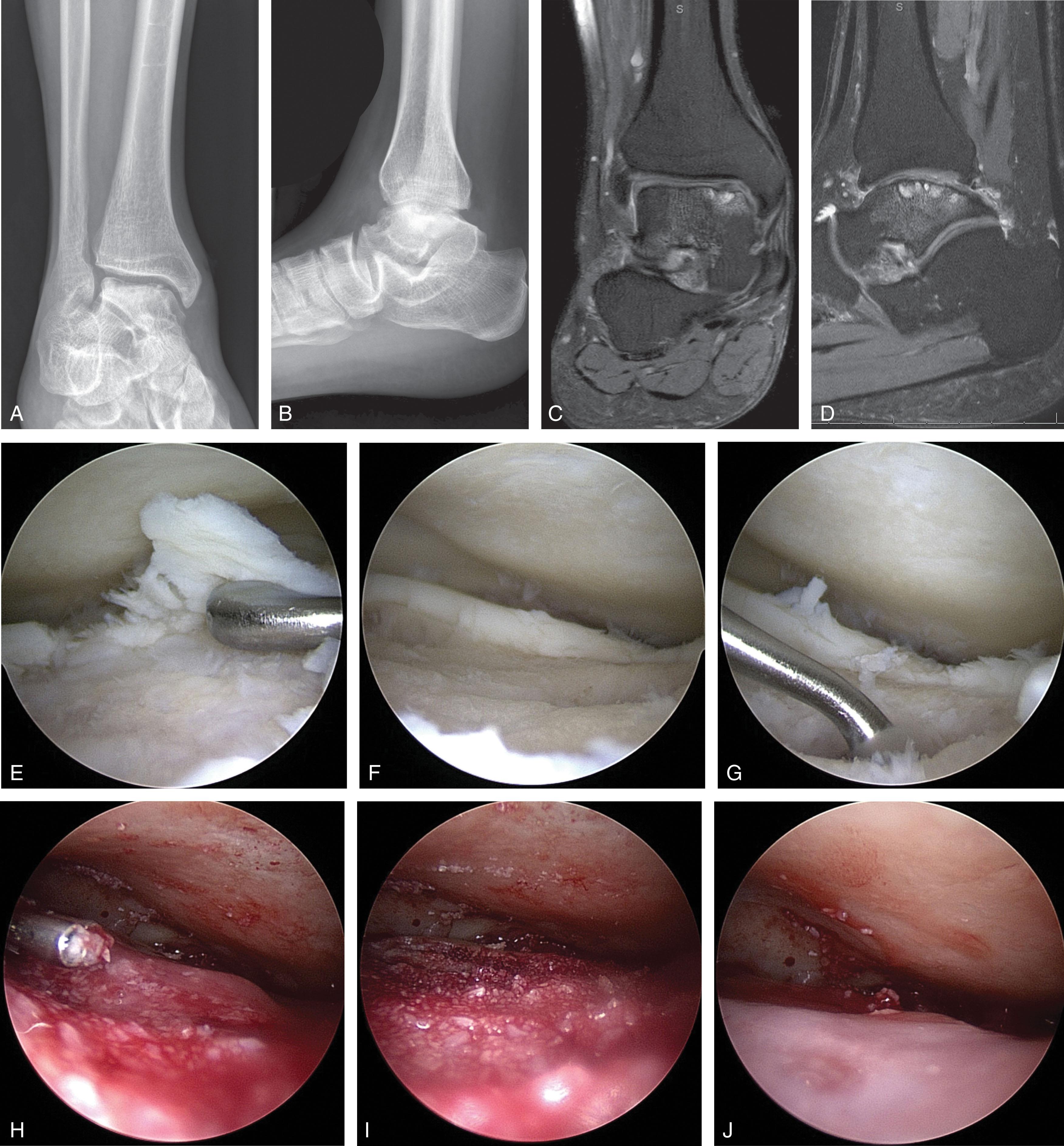 Fig. 40-20, Extracellular matrix cartilage allograft. Radiographs ( A and B ), and MRI scans ( C and D ) of an osteochondral lesion of the medial talar dome. E and F , Arthroscopic view from the anterolateral portal showing debridement of the cartilage flap and underlying bone. G , Microfracture of the prepared subchondral bone is performed with an angled awl. H and I , Granulated extracellular matrix cartilage allograft is applied using a dry arthroscopy technique. J , Fibrin glue has been applied to cover the graft.