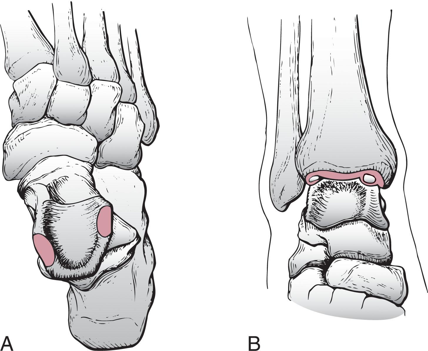 Fig. 40-2, The most common locations for osteochondral lesions of the talus (shaded areas) . A , Location of medial lesions tends to be slightly more posterior; while lateral lesions tend to be more anterior. B , The shape of lateral lesions is usually shallow and wafer-like and is often displaced; medial lesions tend to be deeper, cup shaped, and are usually nondisplaced.